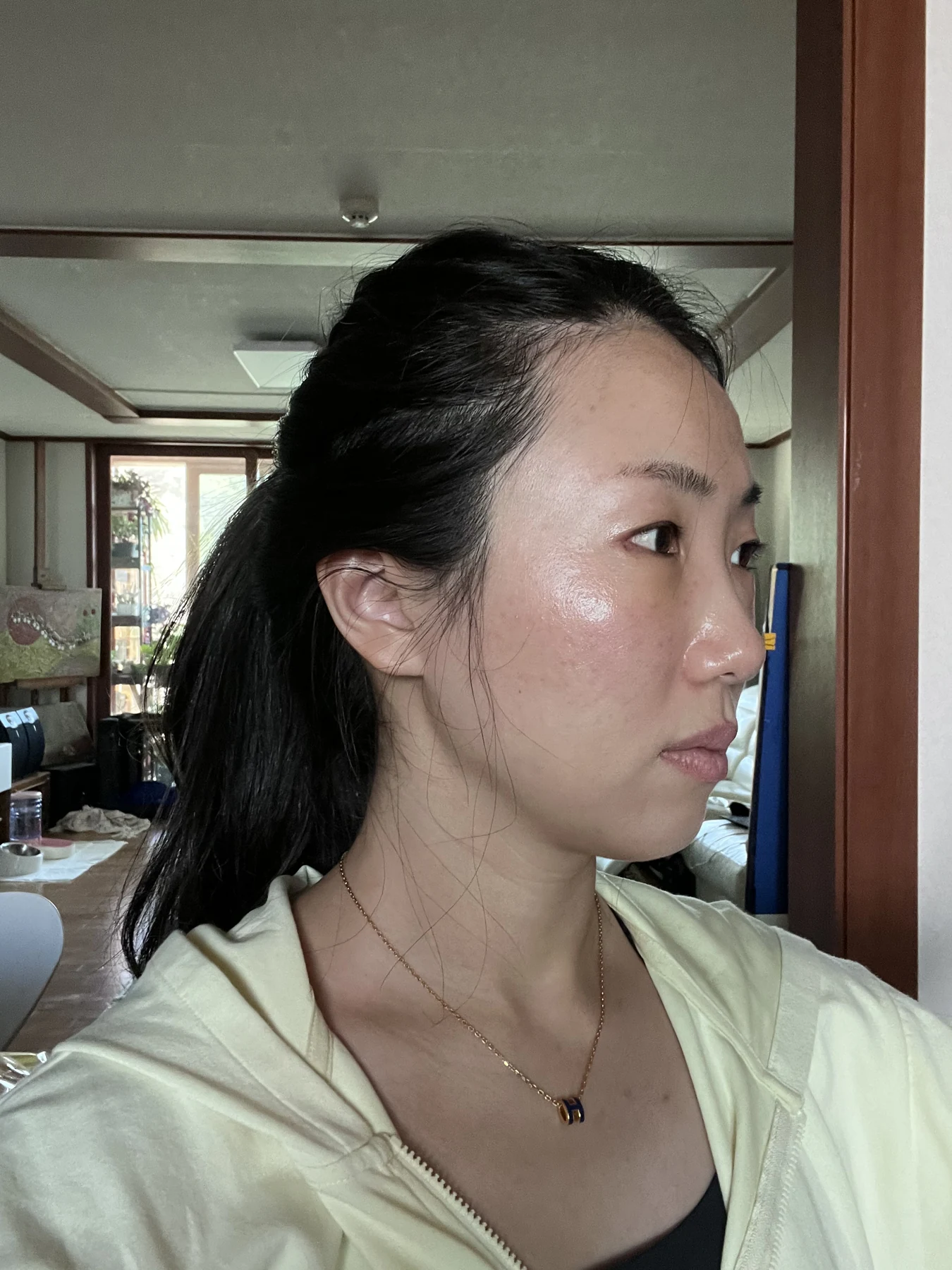 Wonder canthoplasty and under-eye fat repositioning: three-month photo diary · Case 058 at Answer Plastic Surgery. Angled view — 1 week, wonder canthoplasty and under-eye fat repositioning at Answer Plastic Surgery (case 058).