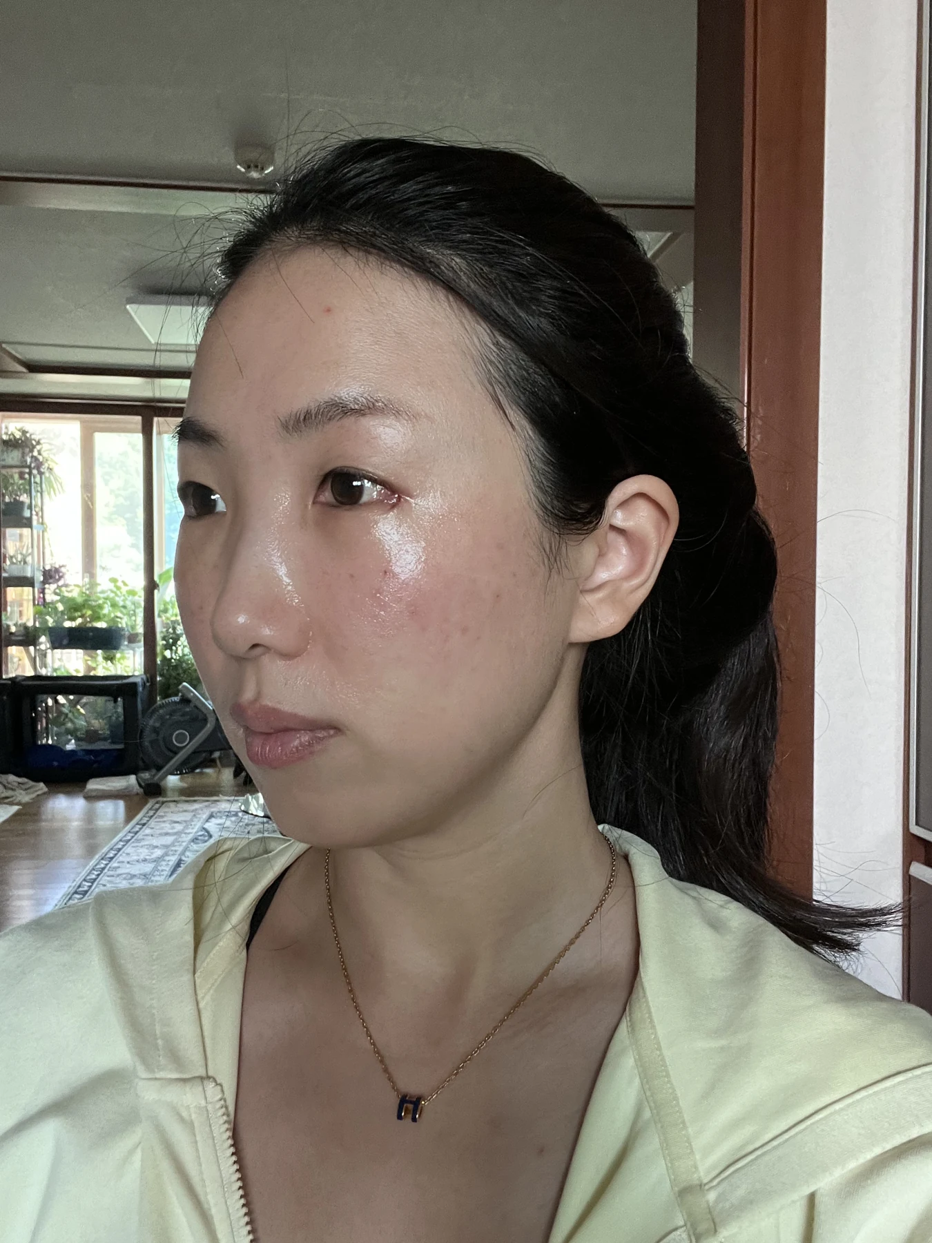 Wonder canthoplasty and under-eye fat repositioning: three-month photo diary · Case 058 at Answer Plastic Surgery. Angled view — 1 week, wonder canthoplasty and under-eye fat repositioning at Answer Plastic Surgery (case 058).