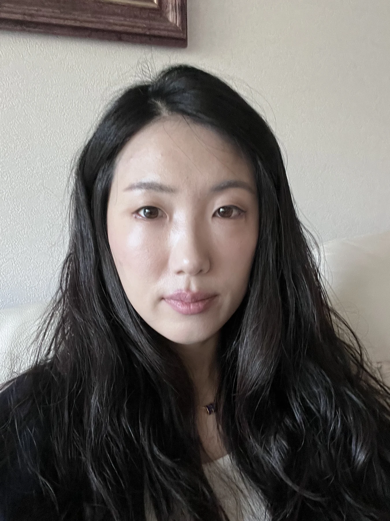 Wonder canthoplasty and under-eye fat repositioning: three-month photo diary · Case 058 at Answer Plastic Surgery. Front view — 2 weeks, wonder canthoplasty and under-eye fat repositioning at Answer Plastic Surgery (case 058).