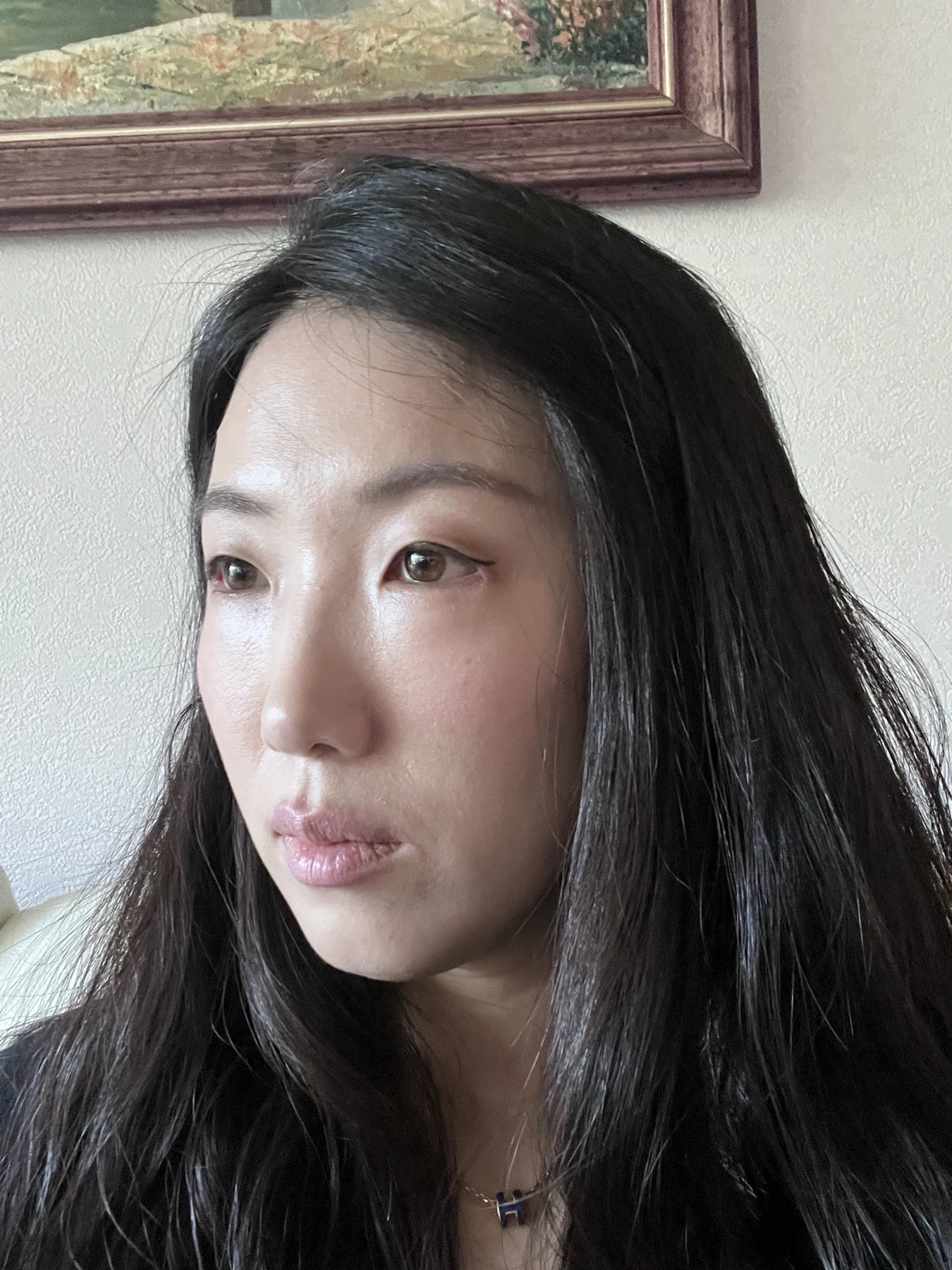 Wonder canthoplasty and under-eye fat repositioning: three-month photo diary · Case 058 at Answer Plastic Surgery. Angled view — 2 weeks, wonder canthoplasty and under-eye fat repositioning at Answer Plastic Surgery (case 058).