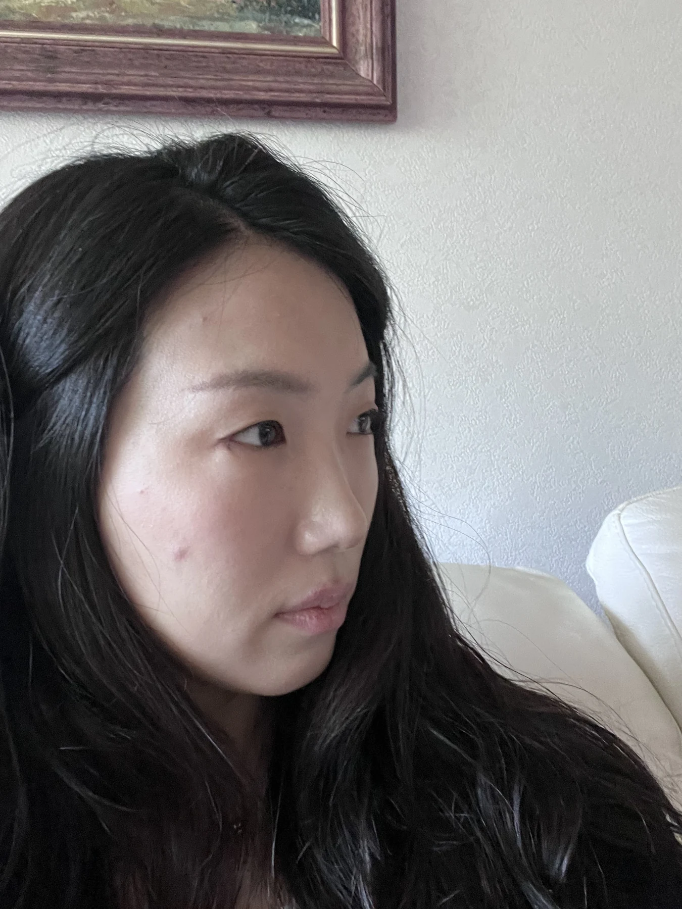 Wonder canthoplasty and under-eye fat repositioning: three-month photo diary · Case 058 at Answer Plastic Surgery. Angled view — 2 weeks, wonder canthoplasty and under-eye fat repositioning at Answer Plastic Surgery (case 058).