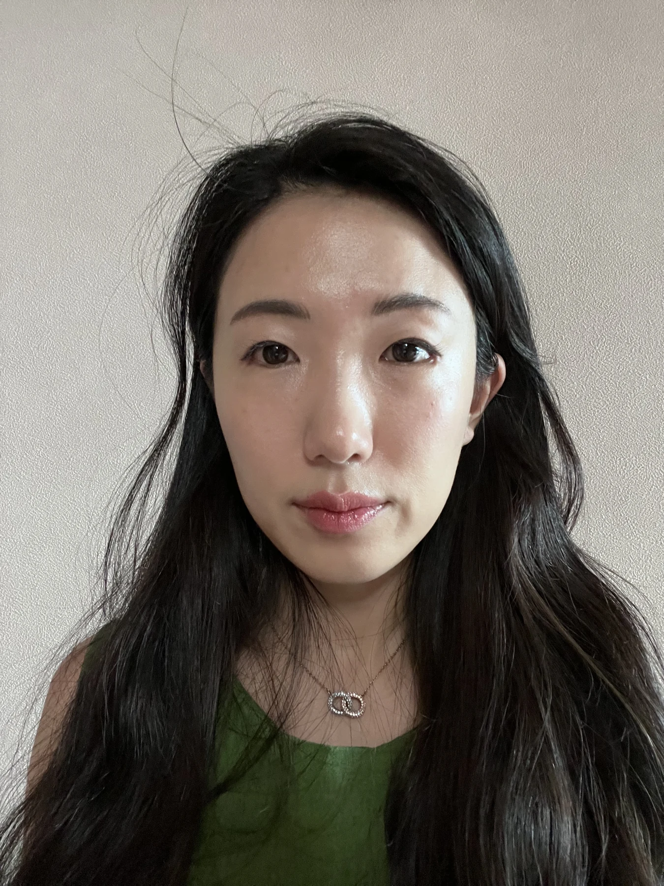 Wonder canthoplasty and under-eye fat repositioning: three-month photo diary · Case 058 at Answer Plastic Surgery. Front view — 1 month, wonder canthoplasty and under-eye fat repositioning at Answer Plastic Surgery (case 058).