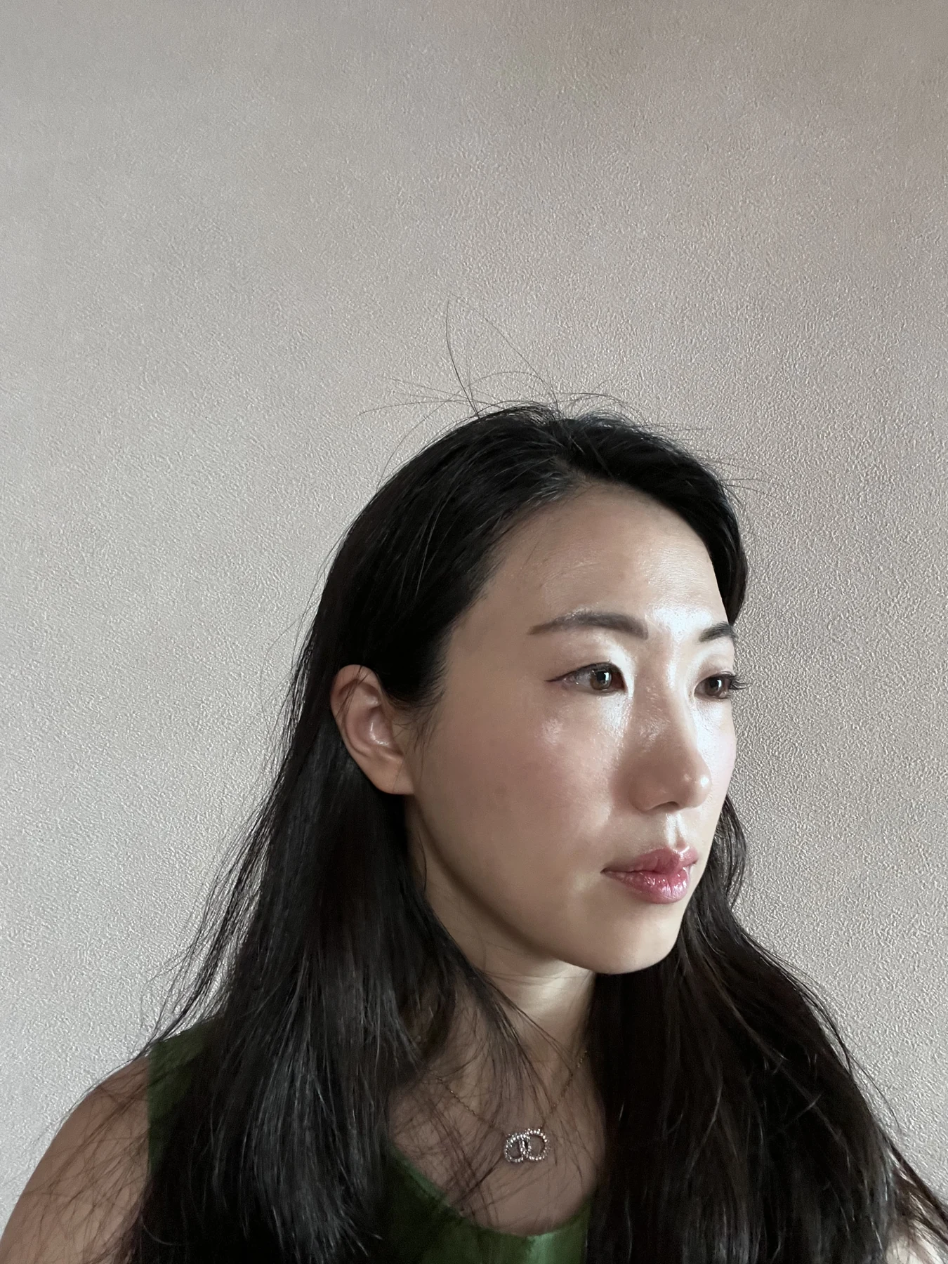 Wonder canthoplasty and under-eye fat repositioning: three-month photo diary · Case 058 at Answer Plastic Surgery. Angled view — 1 month, wonder canthoplasty and under-eye fat repositioning at Answer Plastic Surgery (case 058).