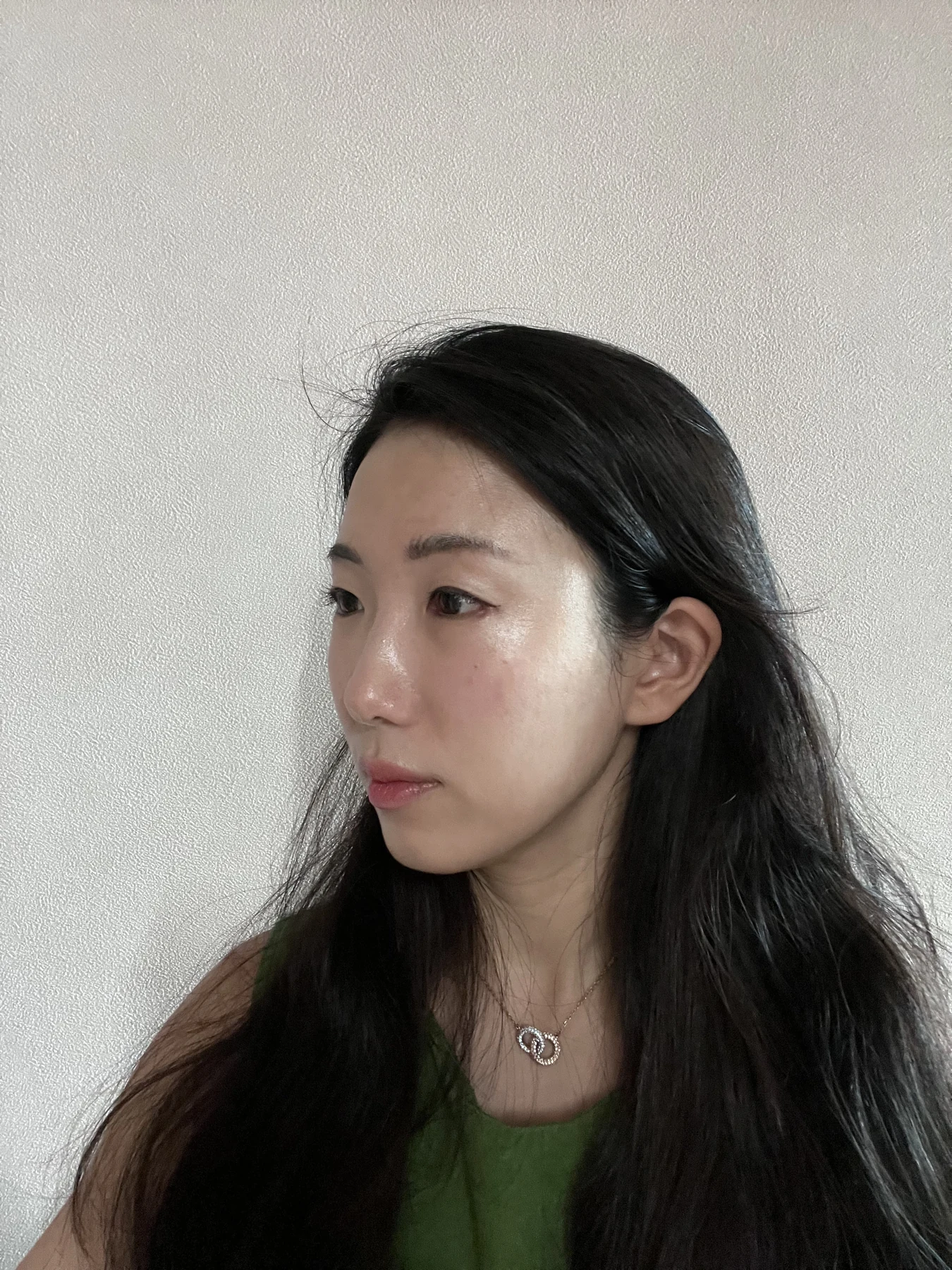 Wonder canthoplasty and under-eye fat repositioning: three-month photo diary · Case 058 at Answer Plastic Surgery. Angled view — 1 month, wonder canthoplasty and under-eye fat repositioning at Answer Plastic Surgery (case 058).