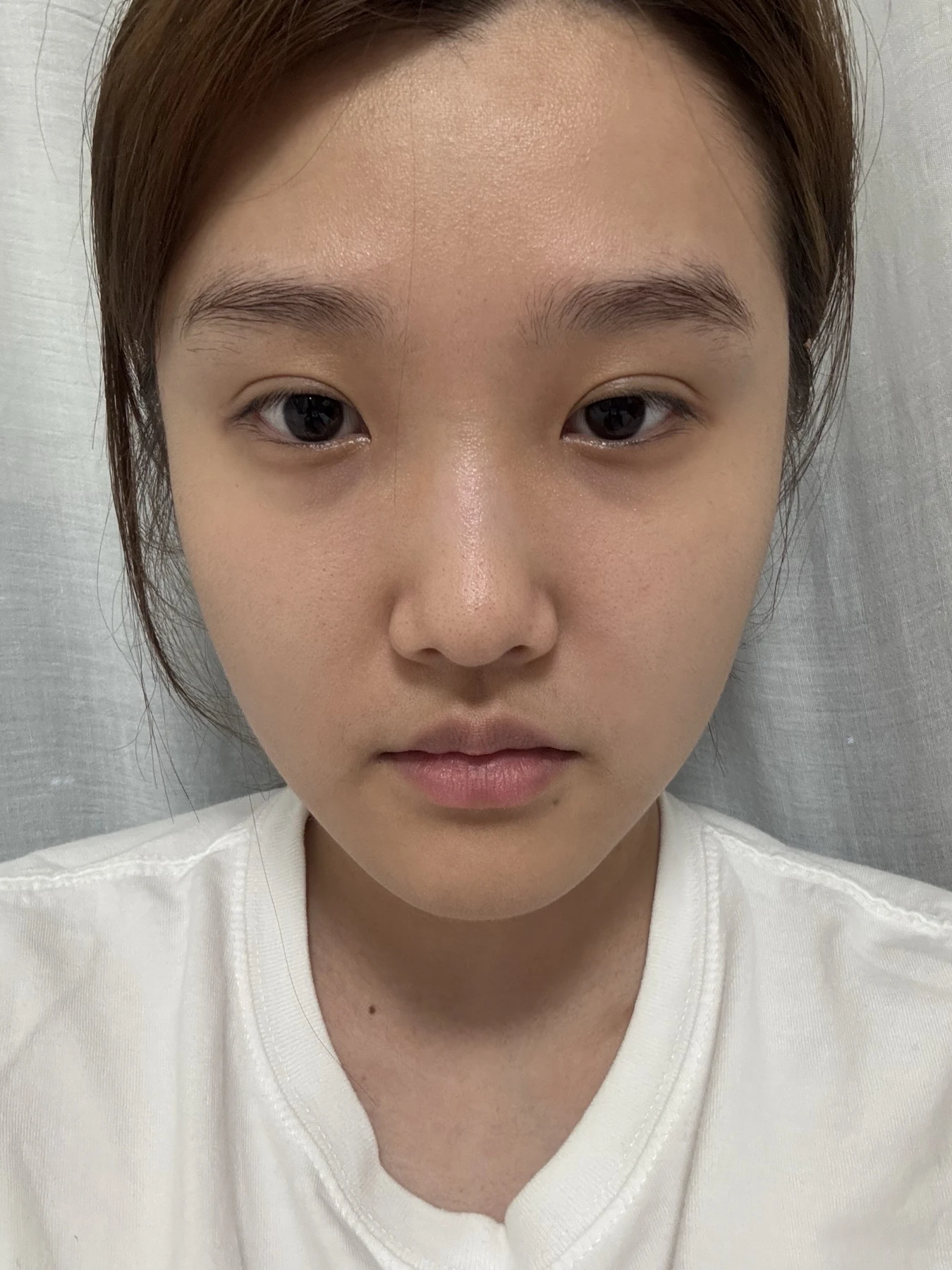 Eye-area before and after: surgery day to one month · Case 059 at Answer Plastic Surgery. Front view — before, eye-area before and after at Answer Plastic Surgery (case 059).