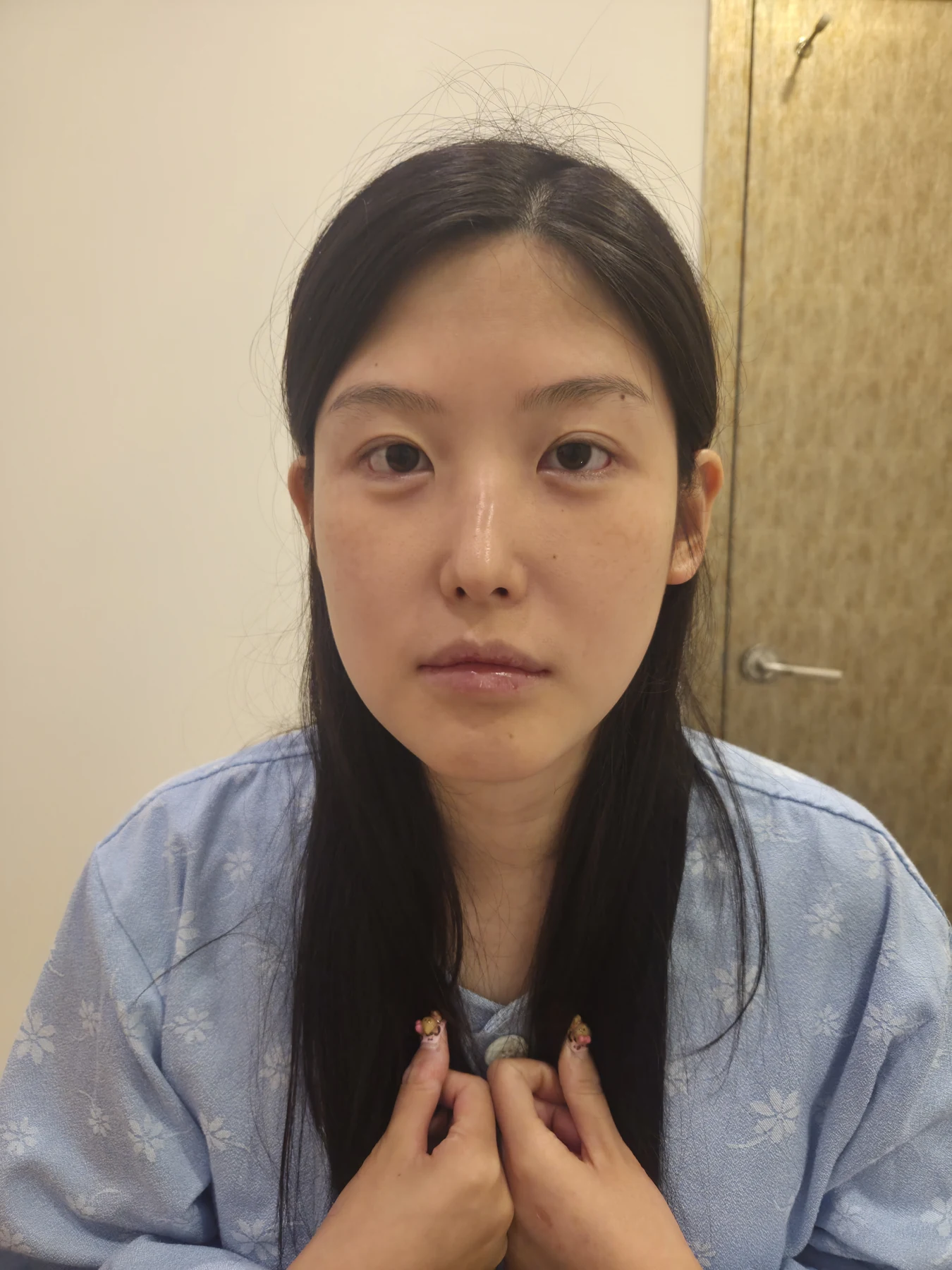 Revision Wonder canthoplasty with lower-corner release: one-month follow-up · Case 060 at Answer Plastic Surgery. Front view — before, revision wonder canthoplasty with lower-corner release at Answer Plastic Surgery (case 060).