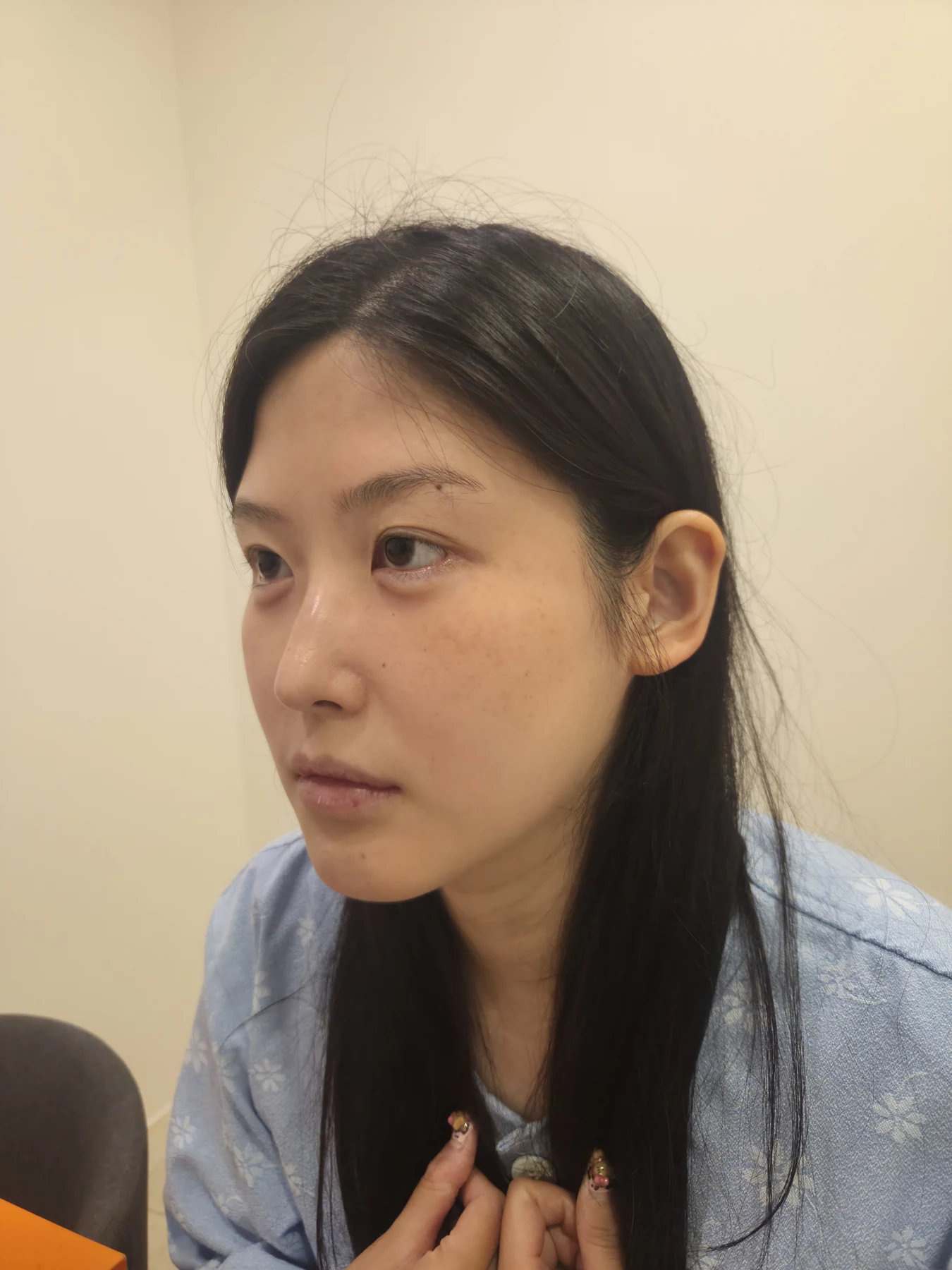 Revision Wonder canthoplasty with lower-corner release: one-month follow-up · Case 060 at Answer Plastic Surgery. Angled view — before, revision wonder canthoplasty with lower-corner release at Answer Plastic Surgery (case 060).
