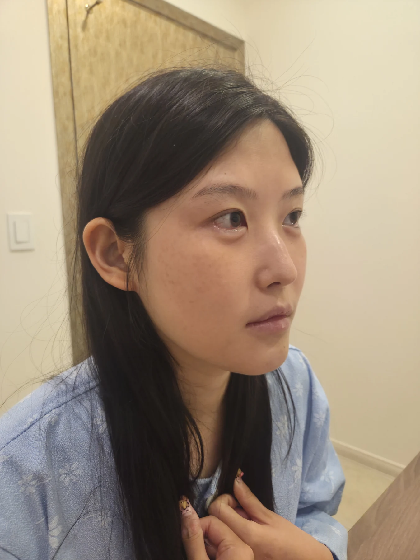 Revision Wonder canthoplasty with lower-corner release: one-month follow-up · Case 060 at Answer Plastic Surgery. Angled view — before, revision wonder canthoplasty with lower-corner release at Answer Plastic Surgery (case 060).