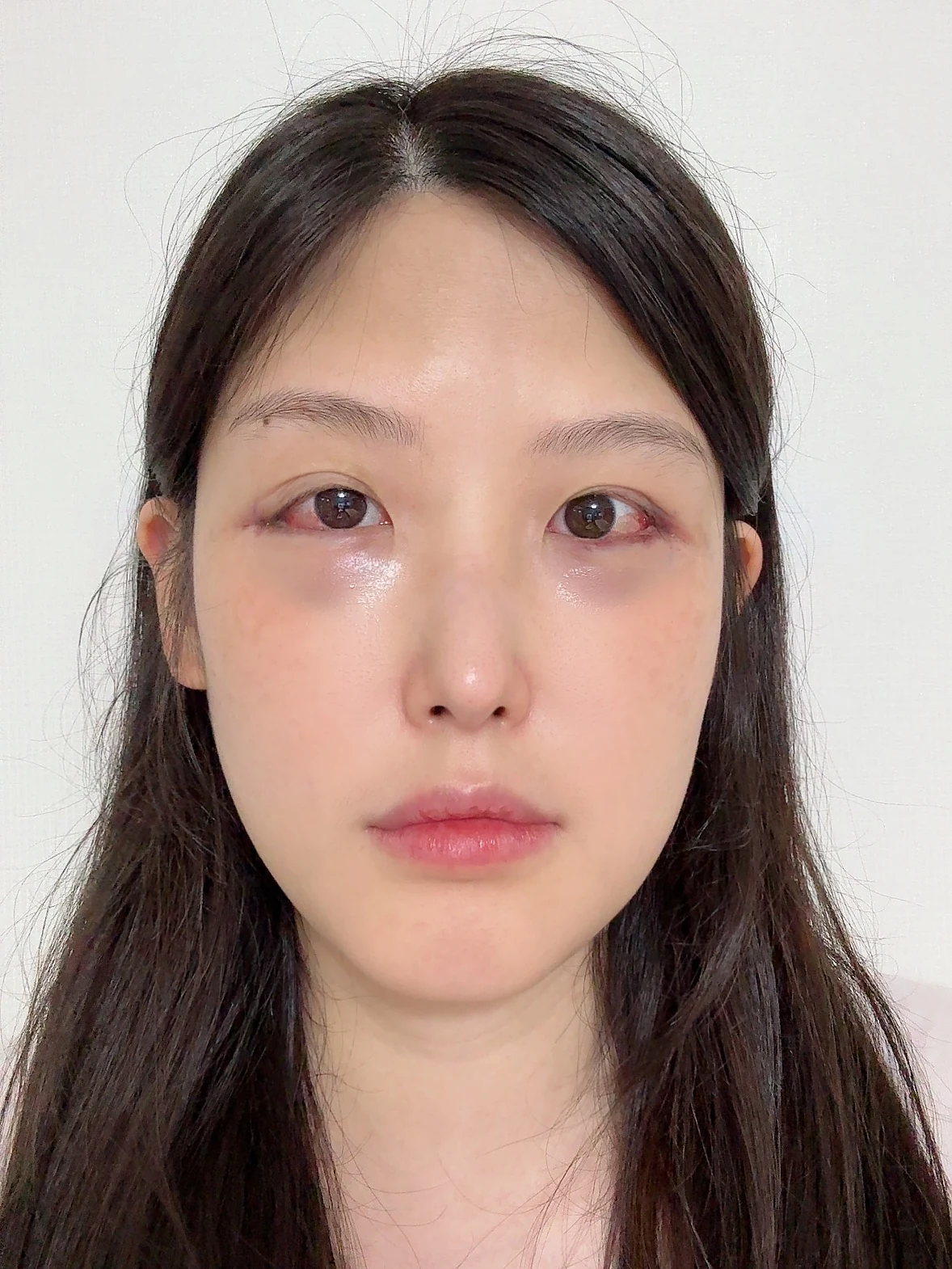 Revision Wonder canthoplasty with lower-corner release: one-month follow-up · Case 060 at Answer Plastic Surgery. Front view — surgery day, revision wonder canthoplasty with lower-corner release at Answer Plastic Surgery (case 060).