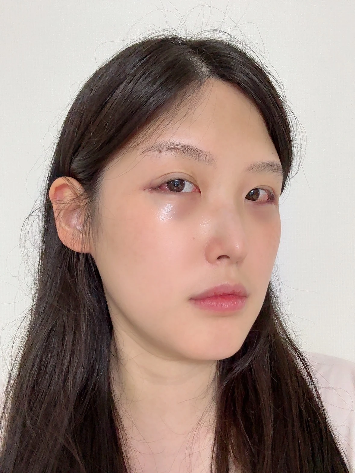 Revision Wonder canthoplasty with lower-corner release: one-month follow-up · Case 060 at Answer Plastic Surgery. Angled view — surgery day, revision wonder canthoplasty with lower-corner release at Answer Plastic Surgery (case 060).