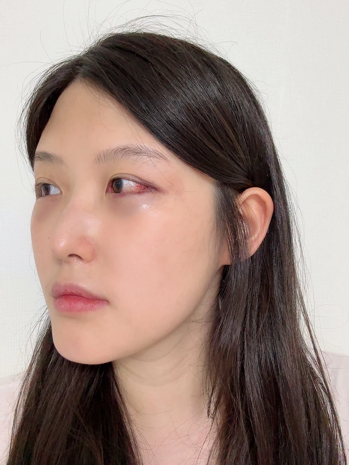 Revision Wonder canthoplasty with lower-corner release: one-month follow-up · Case 060 at Answer Plastic Surgery. Angled view — surgery day, revision wonder canthoplasty with lower-corner release at Answer Plastic Surgery (case 060).