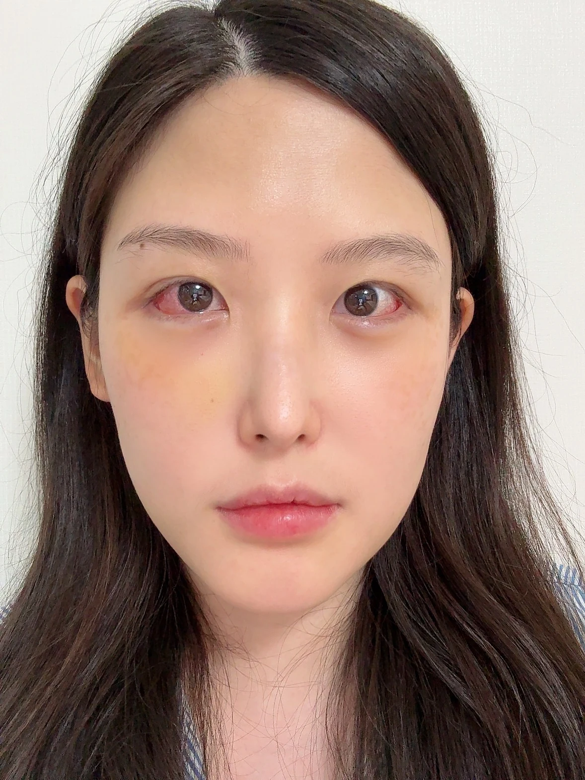 Revision Wonder canthoplasty with lower-corner release: one-month follow-up · Case 060 at Answer Plastic Surgery. Front view — 1 week, revision wonder canthoplasty with lower-corner release at Answer Plastic Surgery (case 060).