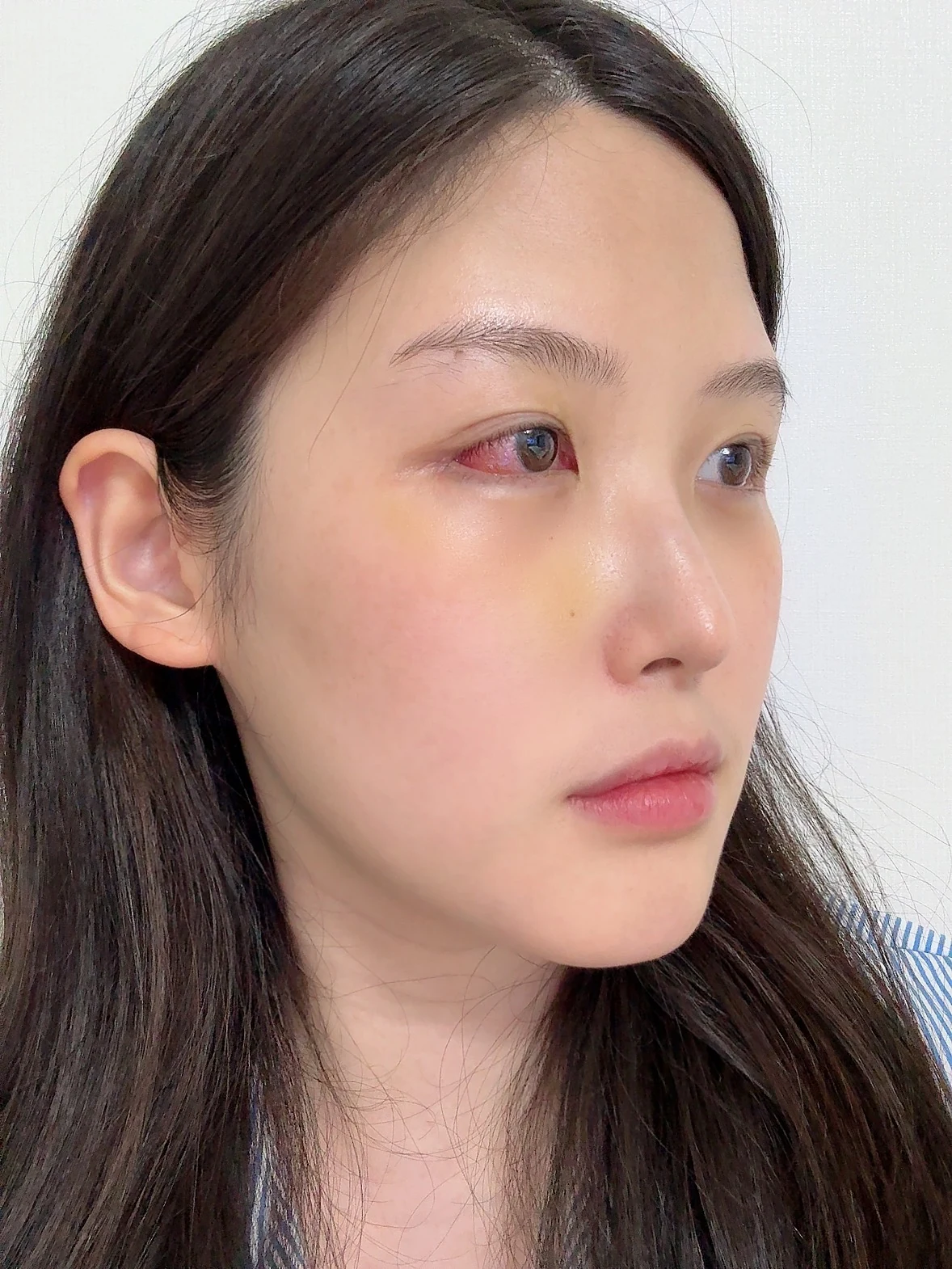 Revision Wonder canthoplasty with lower-corner release: one-month follow-up · Case 060 at Answer Plastic Surgery. Angled view — 1 week, revision wonder canthoplasty with lower-corner release at Answer Plastic Surgery (case 060).