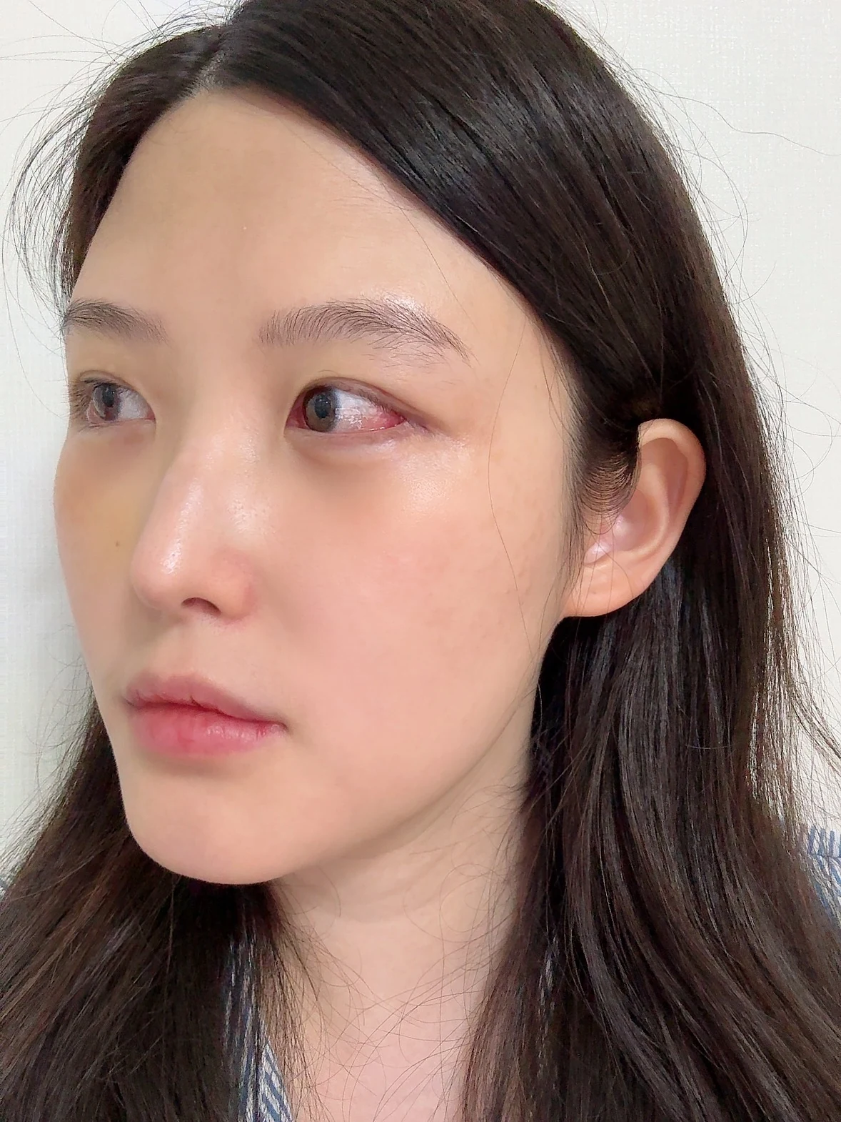 Revision Wonder canthoplasty with lower-corner release: one-month follow-up · Case 060 at Answer Plastic Surgery. Angled view — 1 week, revision wonder canthoplasty with lower-corner release at Answer Plastic Surgery (case 060).