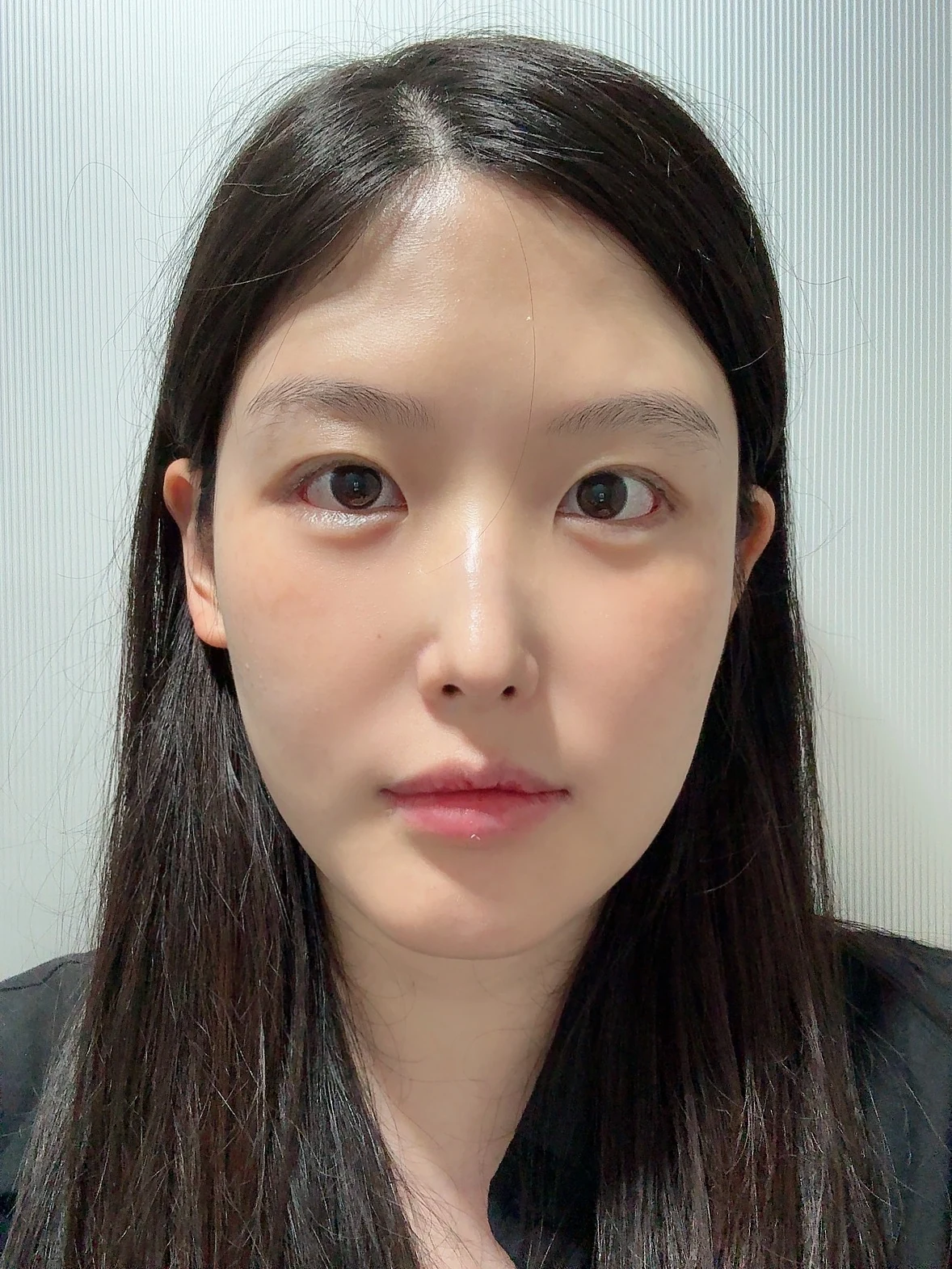 Revision Wonder canthoplasty with lower-corner release: one-month follow-up · Case 060 at Answer Plastic Surgery. Front view — 2 weeks, revision wonder canthoplasty with lower-corner release at Answer Plastic Surgery (case 060).