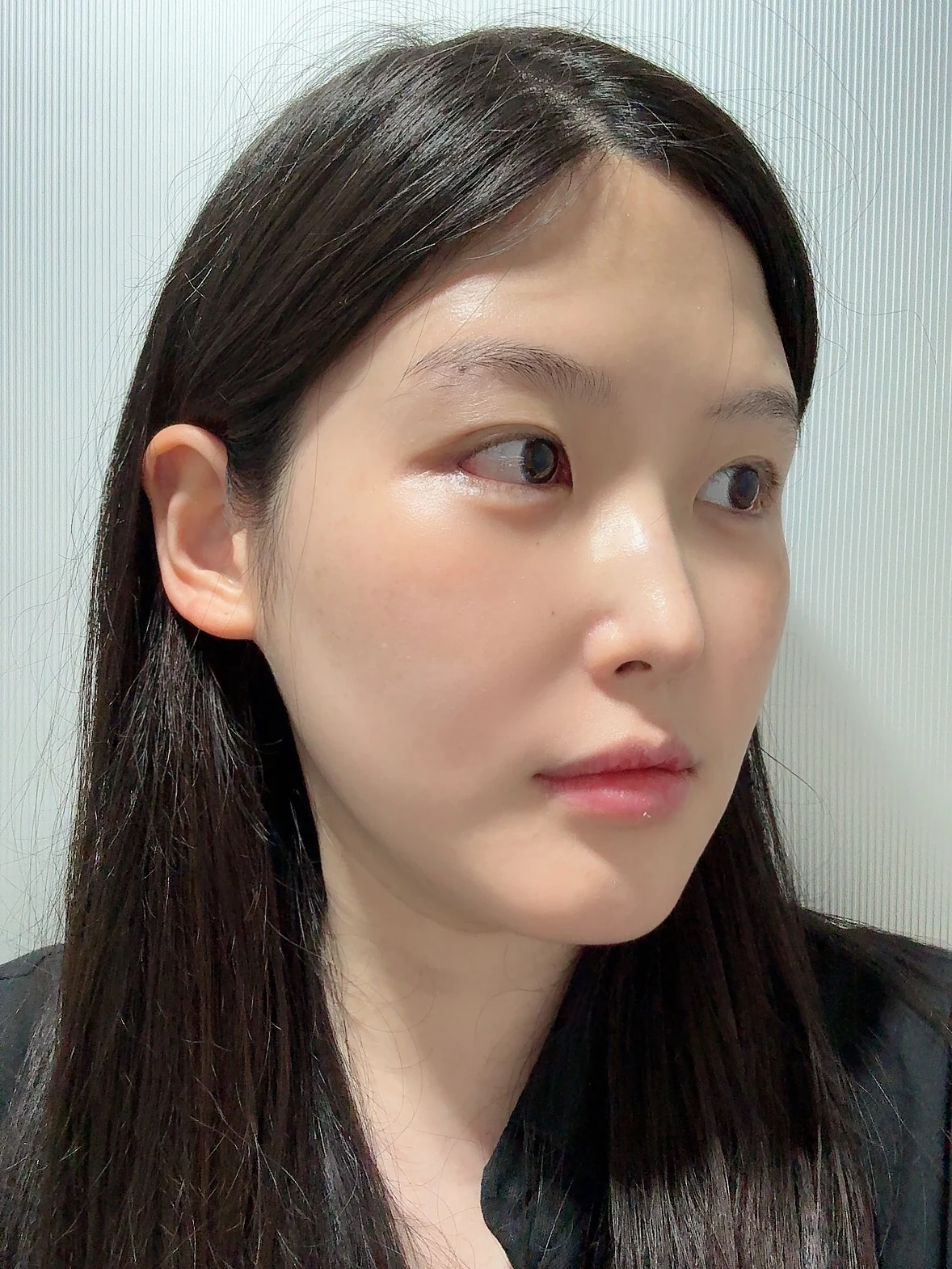Revision Wonder canthoplasty with lower-corner release: one-month follow-up · Case 060 at Answer Plastic Surgery. Angled view — 2 weeks, revision wonder canthoplasty with lower-corner release at Answer Plastic Surgery (case 060).