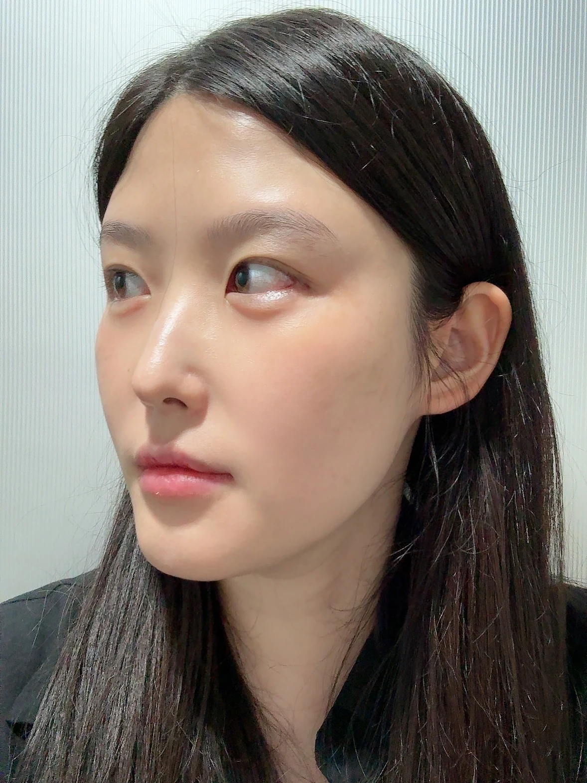 Revision Wonder canthoplasty with lower-corner release: one-month follow-up · Case 060 at Answer Plastic Surgery. Angled view — 2 weeks, revision wonder canthoplasty with lower-corner release at Answer Plastic Surgery (case 060).