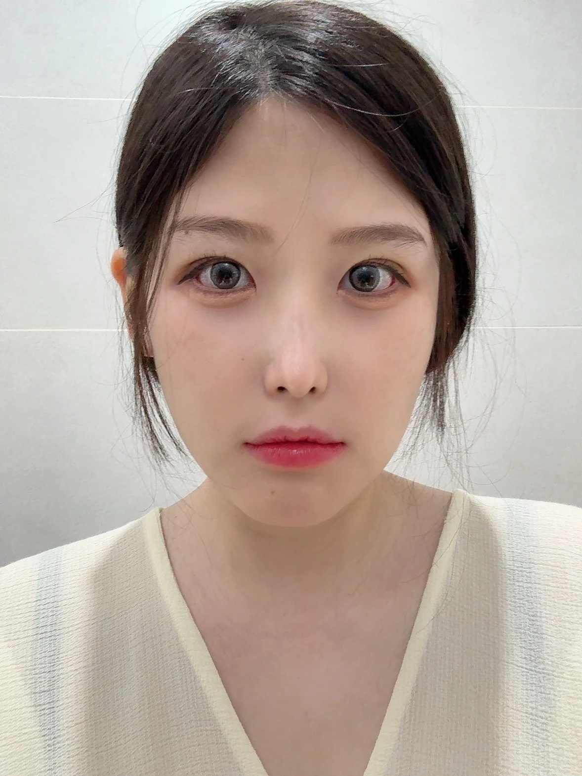 Revision Wonder canthoplasty with lower-corner release: one-month follow-up · Case 060 at Answer Plastic Surgery. Front view — 1 month, revision wonder canthoplasty with lower-corner release at Answer Plastic Surgery (case 060).