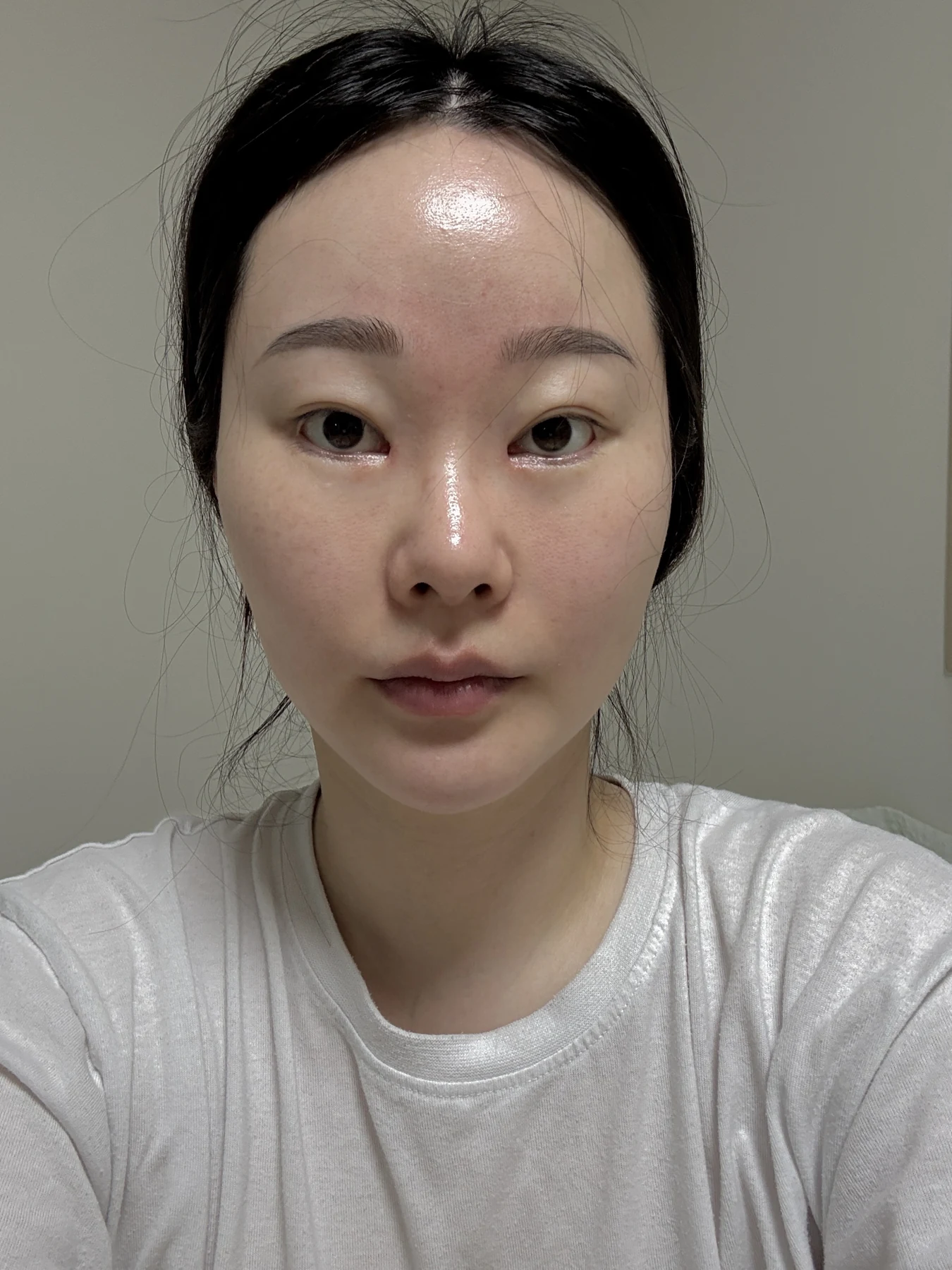 Revision double-eyelid surgery, eye-opening correction and Wonder canthoplasty: three months · Case 061 at Answer Plastic Surgery. Front view — before, revision double-eyelid surgery, eye-opening correction and wonder canthoplasty at Answer Plastic Surgery (case 061).