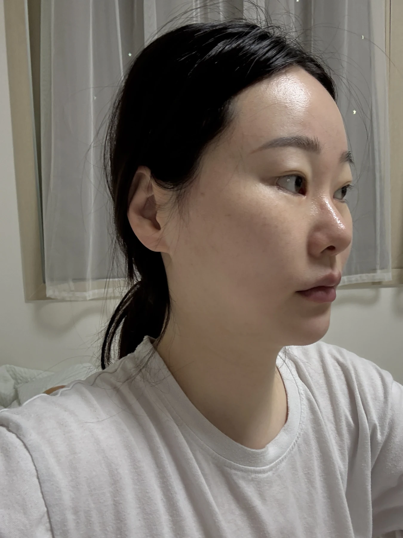 Revision double-eyelid surgery, eye-opening correction and Wonder canthoplasty: three months · Case 061 at Answer Plastic Surgery. Angled view — before, revision double-eyelid surgery, eye-opening correction and wonder canthoplasty at Answer Plastic Surgery (case 061).