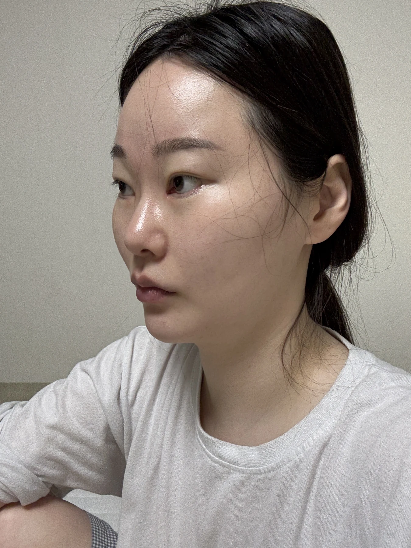 Revision double-eyelid surgery, eye-opening correction and Wonder canthoplasty: three months · Case 061 at Answer Plastic Surgery. Angled view — before, revision double-eyelid surgery, eye-opening correction and wonder canthoplasty at Answer Plastic Surgery (case 061).