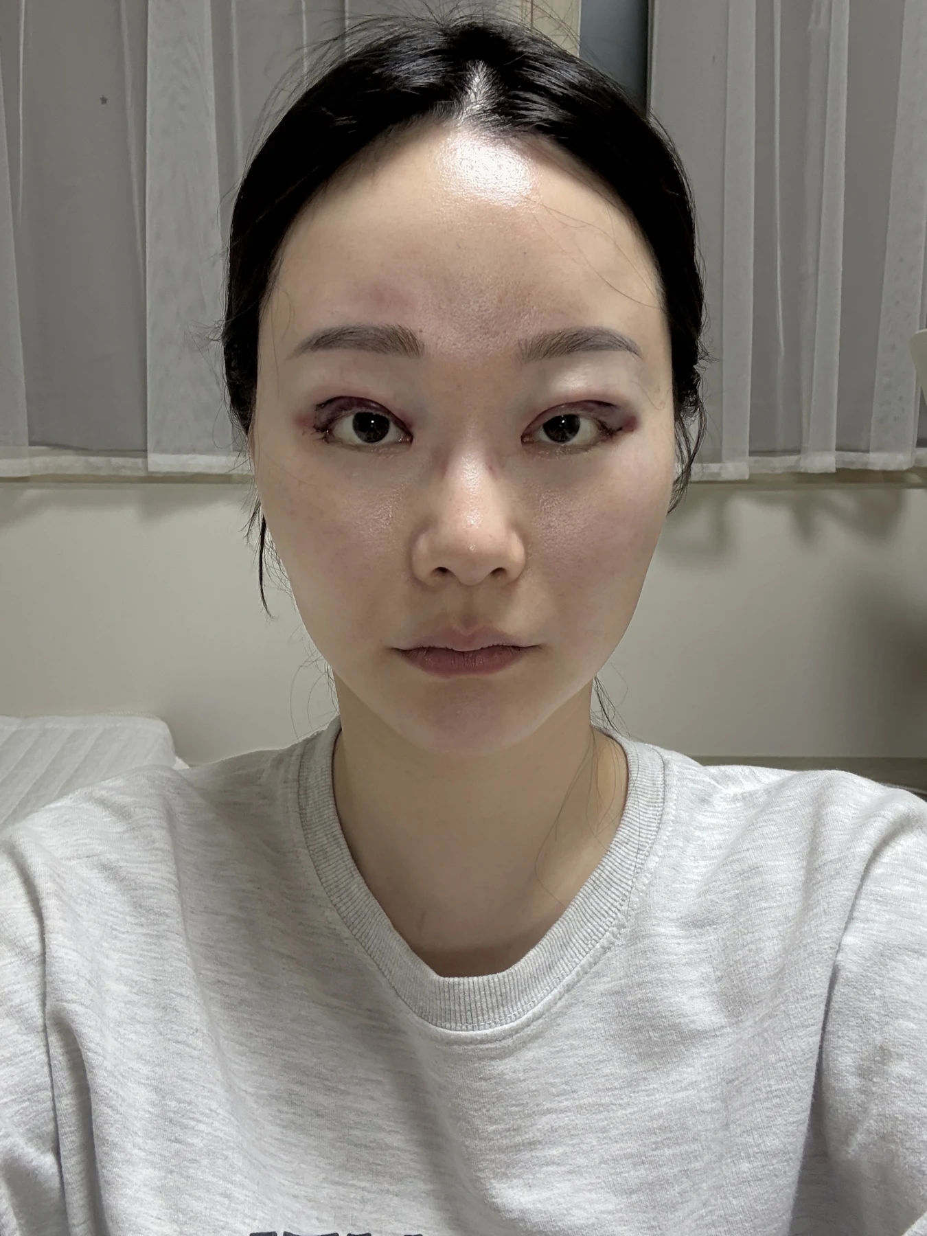 Revision double-eyelid surgery, eye-opening correction and Wonder canthoplasty: three months · Case 061 at Answer Plastic Surgery. Front view — surgery day, revision double-eyelid surgery, eye-opening correction and wonder canthoplasty at Answer Plastic Surgery (case 061).