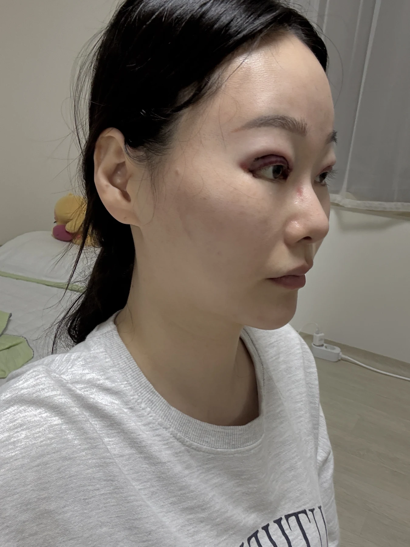 Revision double-eyelid surgery, eye-opening correction and Wonder canthoplasty: three months · Case 061 at Answer Plastic Surgery. Angled view — surgery day, revision double-eyelid surgery, eye-opening correction and wonder canthoplasty at Answer Plastic Surgery (case 061).