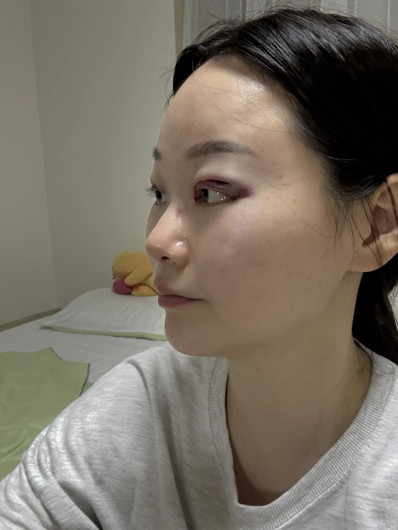 Revision double-eyelid surgery, eye-opening correction and Wonder canthoplasty: three months · Case 061 at Answer Plastic Surgery. Angled view — surgery day, revision double-eyelid surgery, eye-opening correction and wonder canthoplasty at Answer Plastic Surgery (case 061).