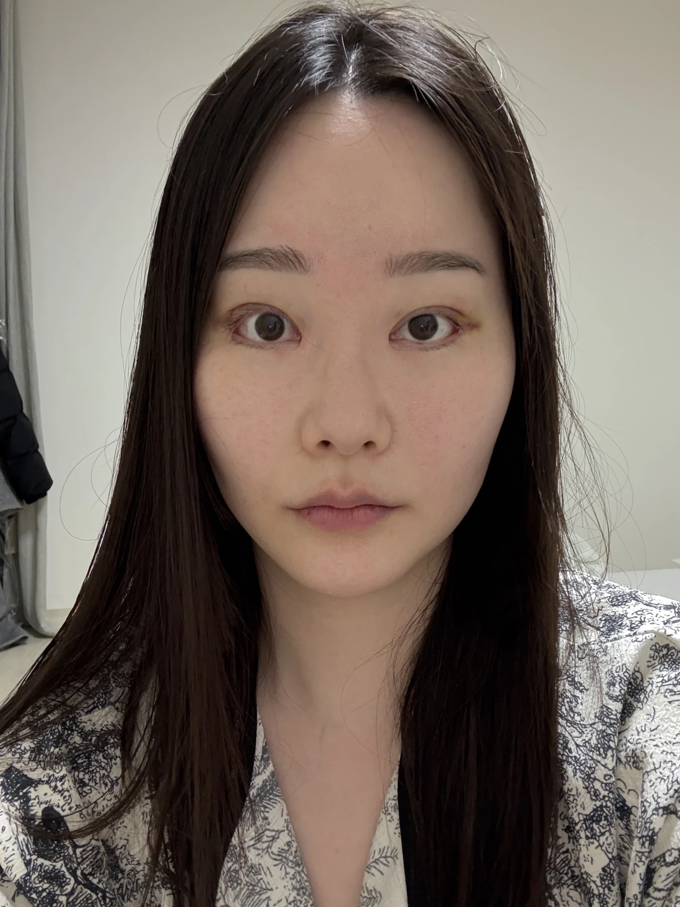 Revision double-eyelid surgery, eye-opening correction and Wonder canthoplasty: three months · Case 061 at Answer Plastic Surgery. Front view — 1 week, revision double-eyelid surgery, eye-opening correction and wonder canthoplasty at Answer Plastic Surgery (case 061).