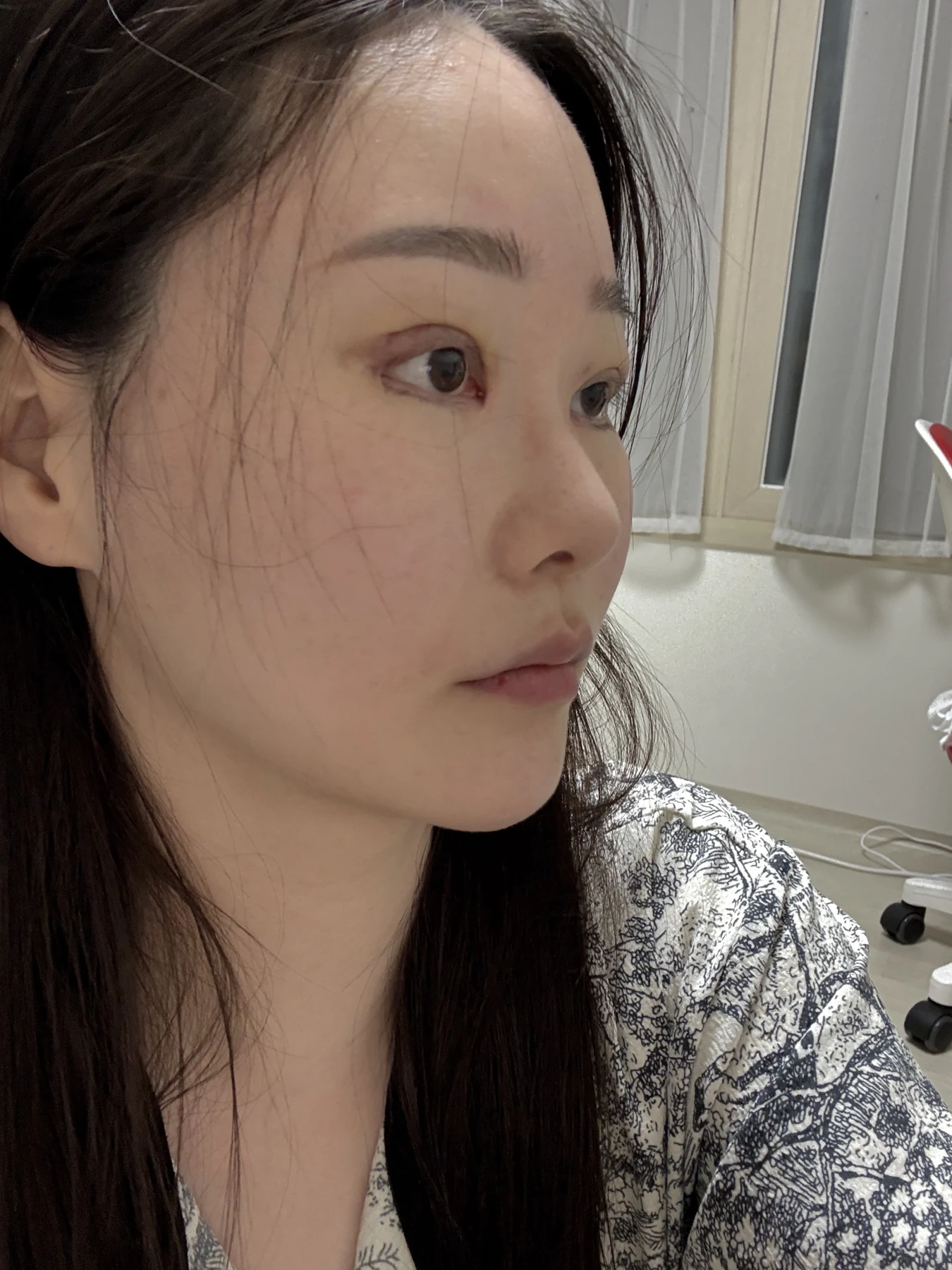 Revision double-eyelid surgery, eye-opening correction and Wonder canthoplasty: three months · Case 061 at Answer Plastic Surgery. Angled view — 1 week, revision double-eyelid surgery, eye-opening correction and wonder canthoplasty at Answer Plastic Surgery (case 061).