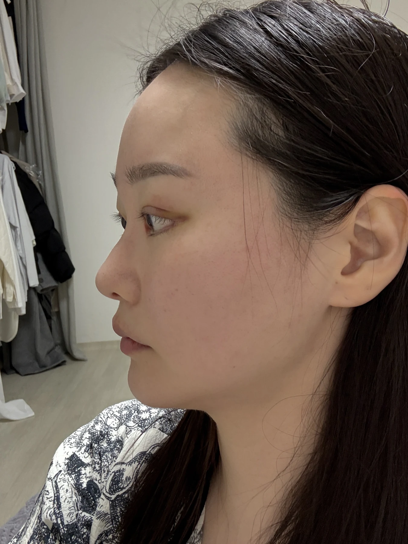 Revision double-eyelid surgery, eye-opening correction and Wonder canthoplasty: three months · Case 061 at Answer Plastic Surgery. Angled view — 1 week, revision double-eyelid surgery, eye-opening correction and wonder canthoplasty at Answer Plastic Surgery (case 061).