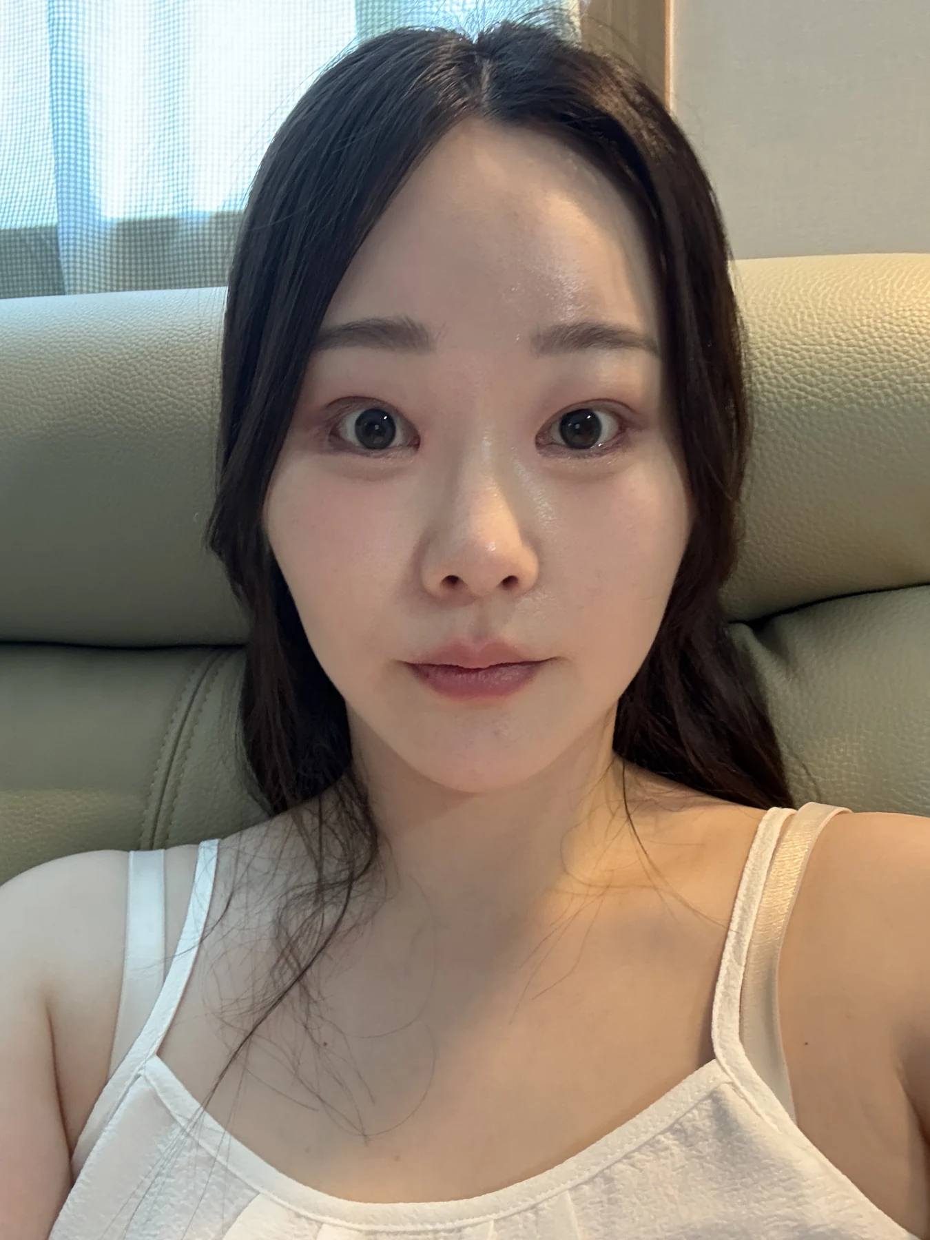 Revision double-eyelid surgery, eye-opening correction and Wonder canthoplasty: three months · Case 061 at Answer Plastic Surgery. Front view — 2 weeks, revision double-eyelid surgery, eye-opening correction and wonder canthoplasty at Answer Plastic Surgery (case 061).