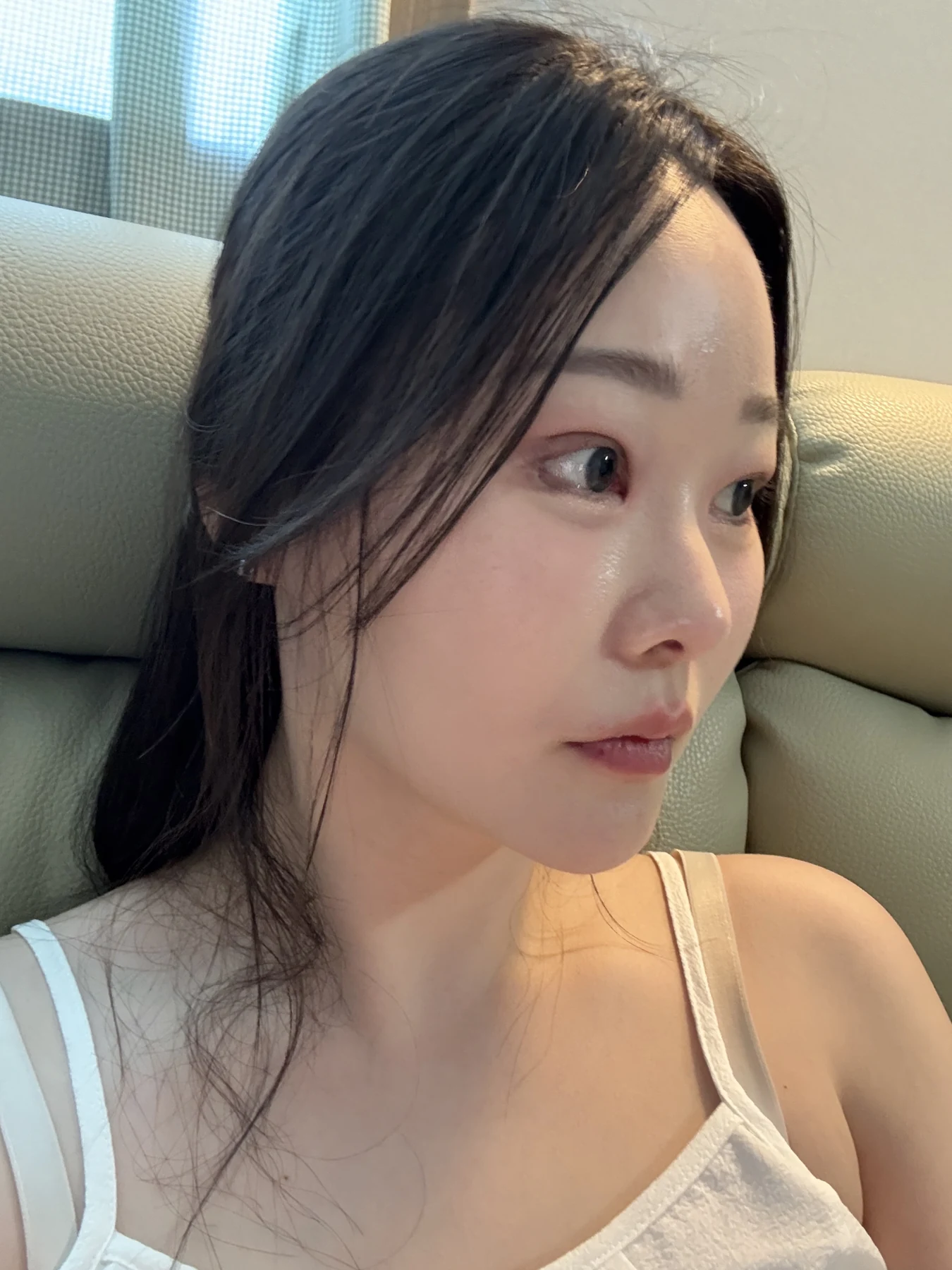 Revision double-eyelid surgery, eye-opening correction and Wonder canthoplasty: three months · Case 061 at Answer Plastic Surgery. Angled view — 2 weeks, revision double-eyelid surgery, eye-opening correction and wonder canthoplasty at Answer Plastic Surgery (case 061).