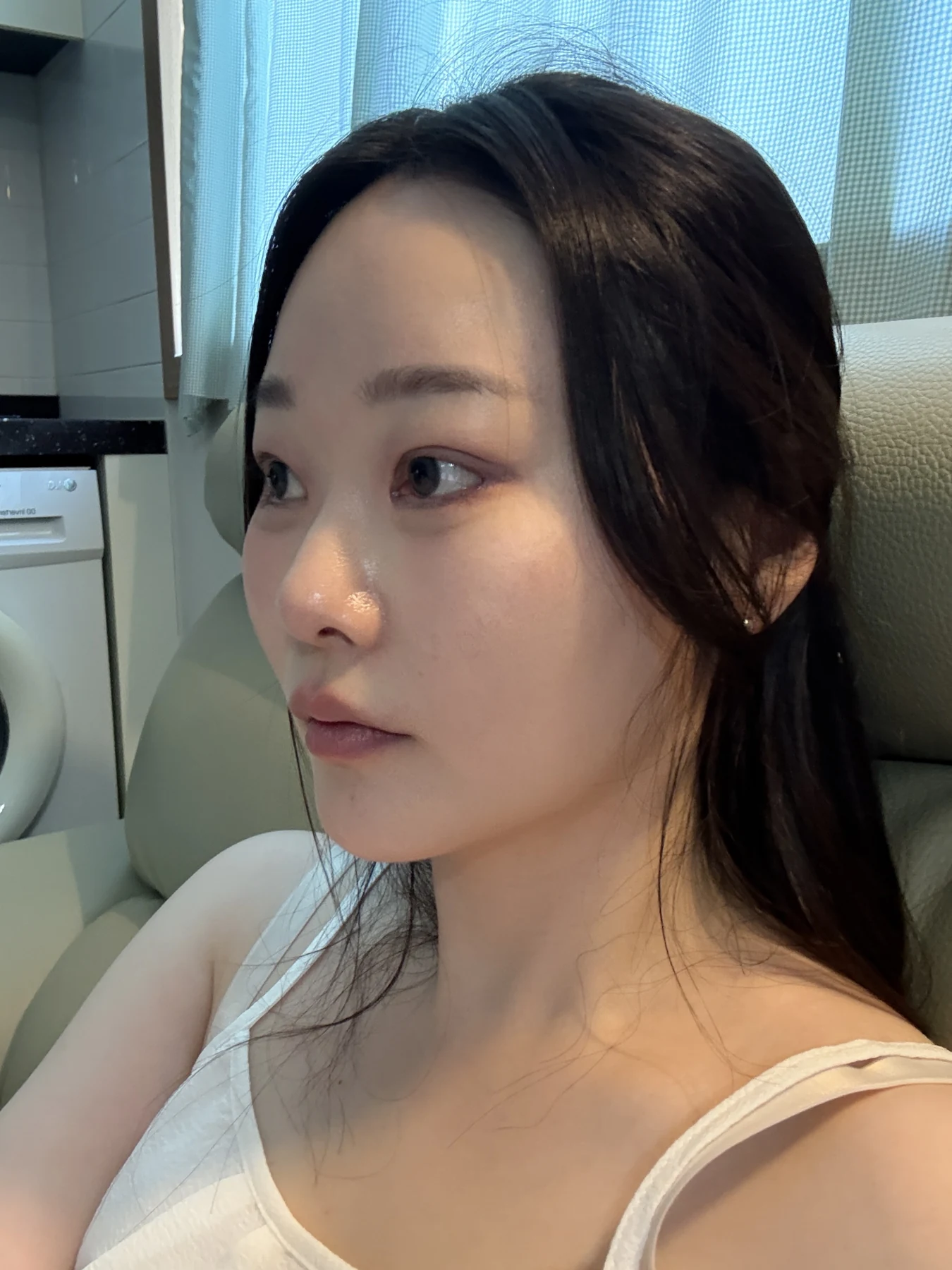 Revision double-eyelid surgery, eye-opening correction and Wonder canthoplasty: three months · Case 061 at Answer Plastic Surgery. Angled view — 2 weeks, revision double-eyelid surgery, eye-opening correction and wonder canthoplasty at Answer Plastic Surgery (case 061).
