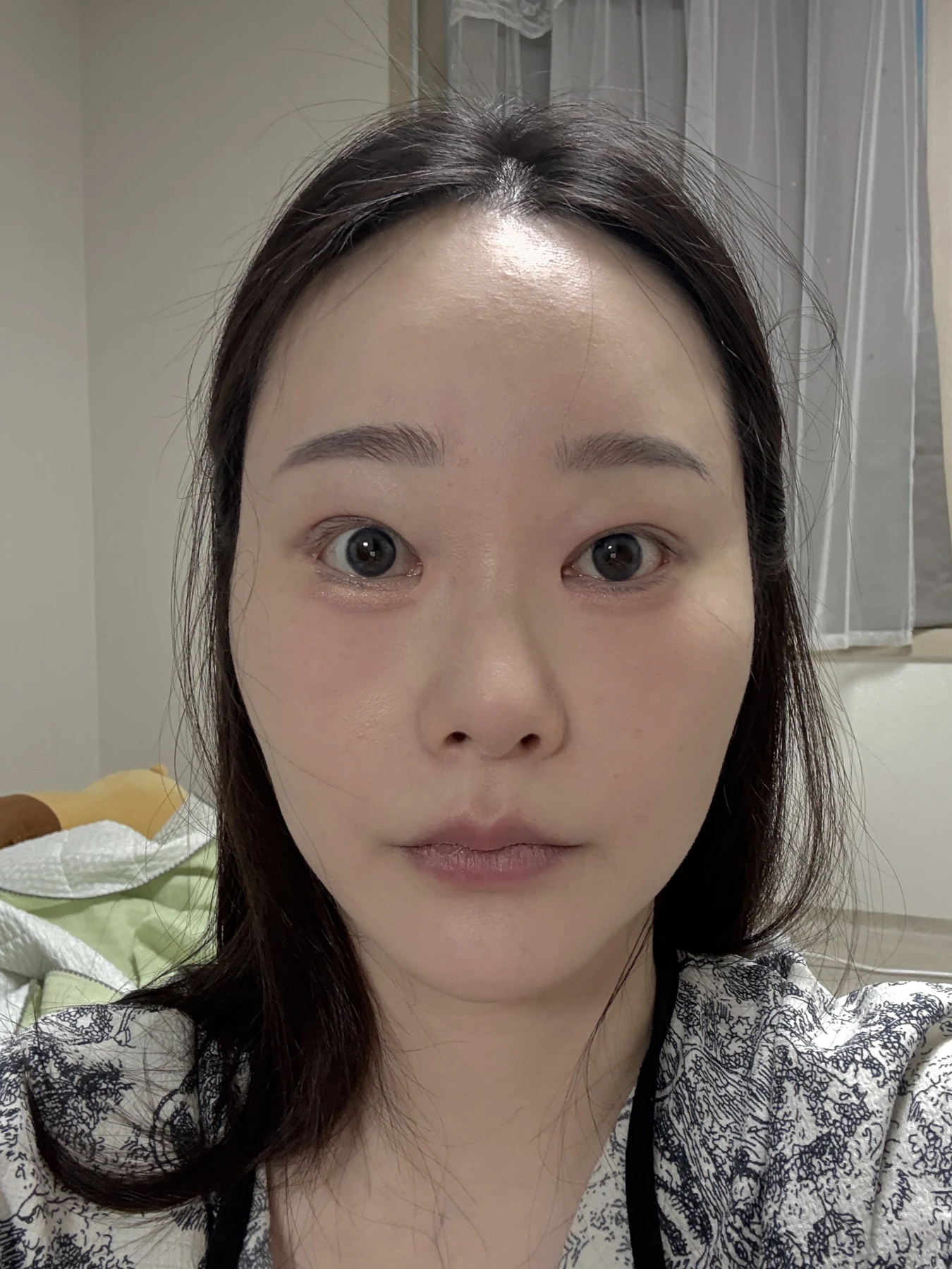 Revision double-eyelid surgery, eye-opening correction and Wonder canthoplasty: three months · Case 061 at Answer Plastic Surgery. Front view — 3 weeks, revision double-eyelid surgery, eye-opening correction and wonder canthoplasty at Answer Plastic Surgery (case 061).