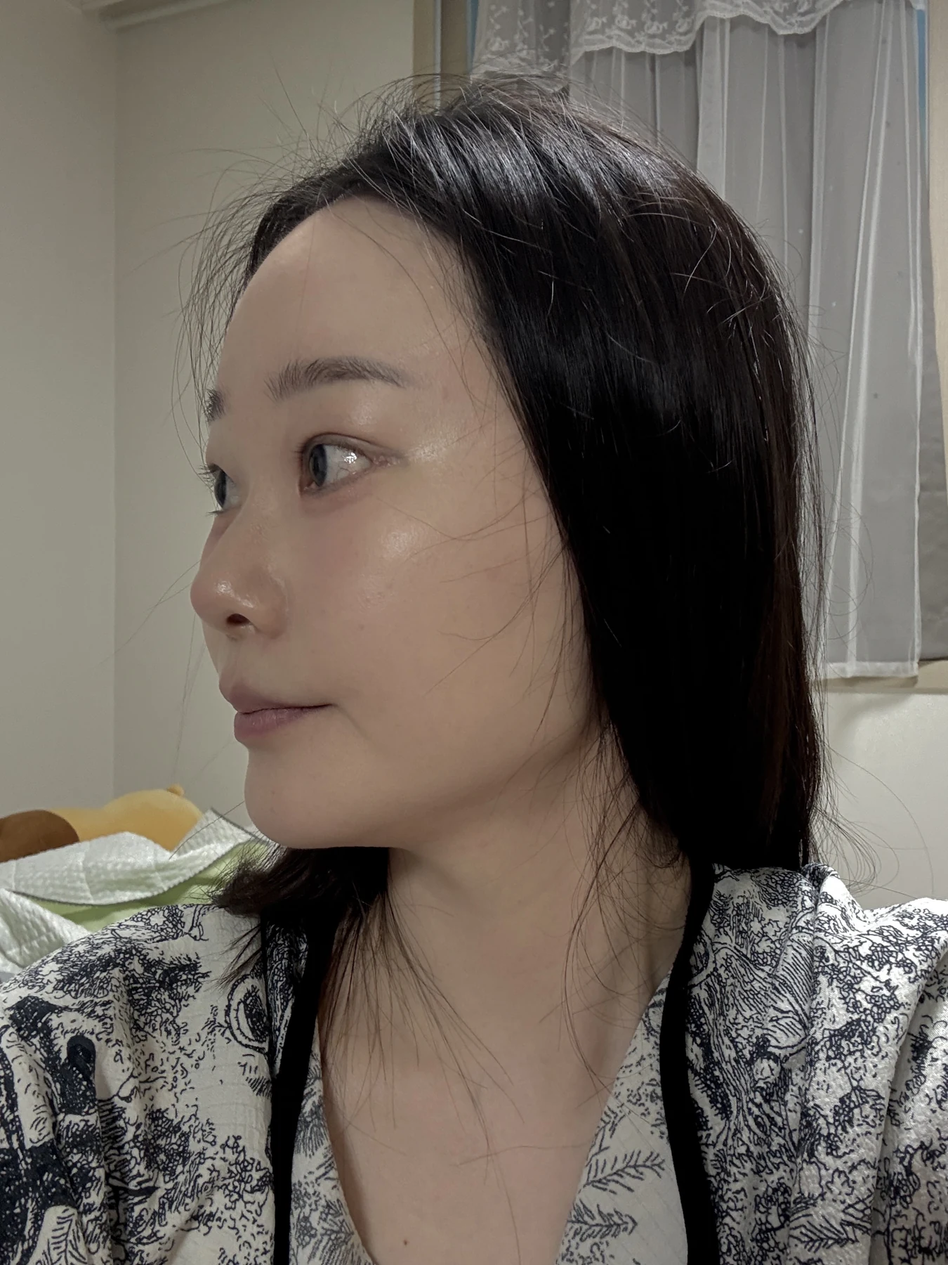 Revision double-eyelid surgery, eye-opening correction and Wonder canthoplasty: three months · Case 061 at Answer Plastic Surgery. Angled view — 3 weeks, revision double-eyelid surgery, eye-opening correction and wonder canthoplasty at Answer Plastic Surgery (case 061).
