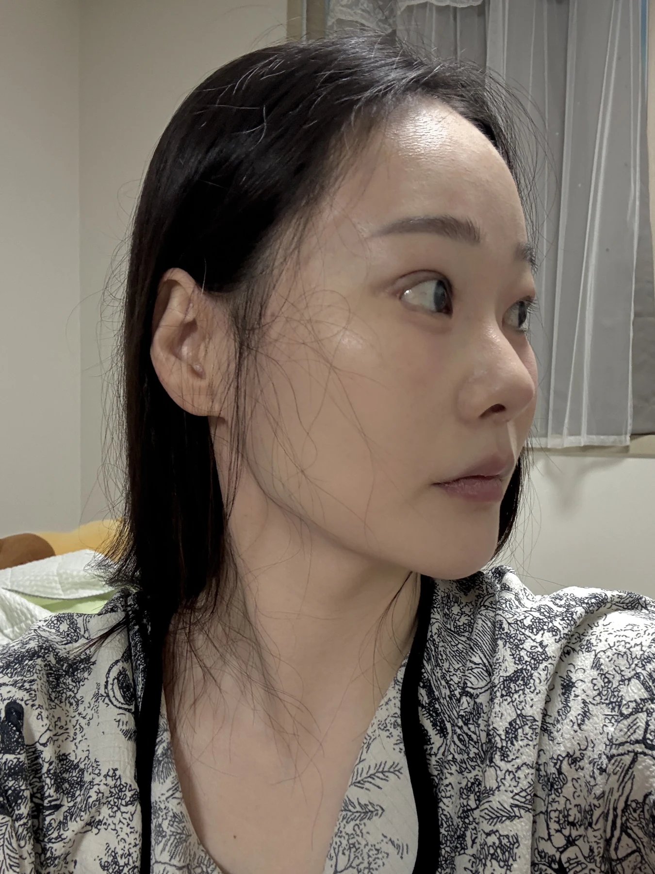 Revision double-eyelid surgery, eye-opening correction and Wonder canthoplasty: three months · Case 061 at Answer Plastic Surgery. Angled view — 3 weeks, revision double-eyelid surgery, eye-opening correction and wonder canthoplasty at Answer Plastic Surgery (case 061).