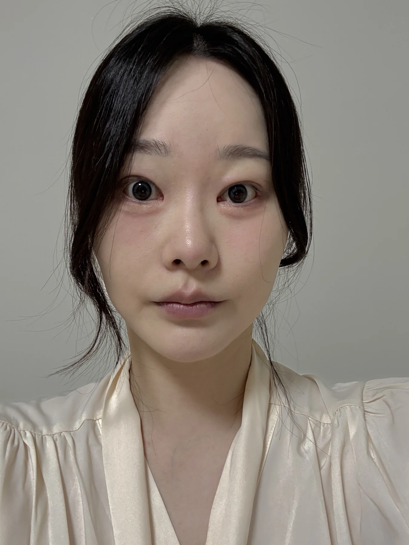 Revision double-eyelid surgery, eye-opening correction and Wonder canthoplasty: three months · Case 061 at Answer Plastic Surgery. Front view — 1 month, revision double-eyelid surgery, eye-opening correction and wonder canthoplasty at Answer Plastic Surgery (case 061).