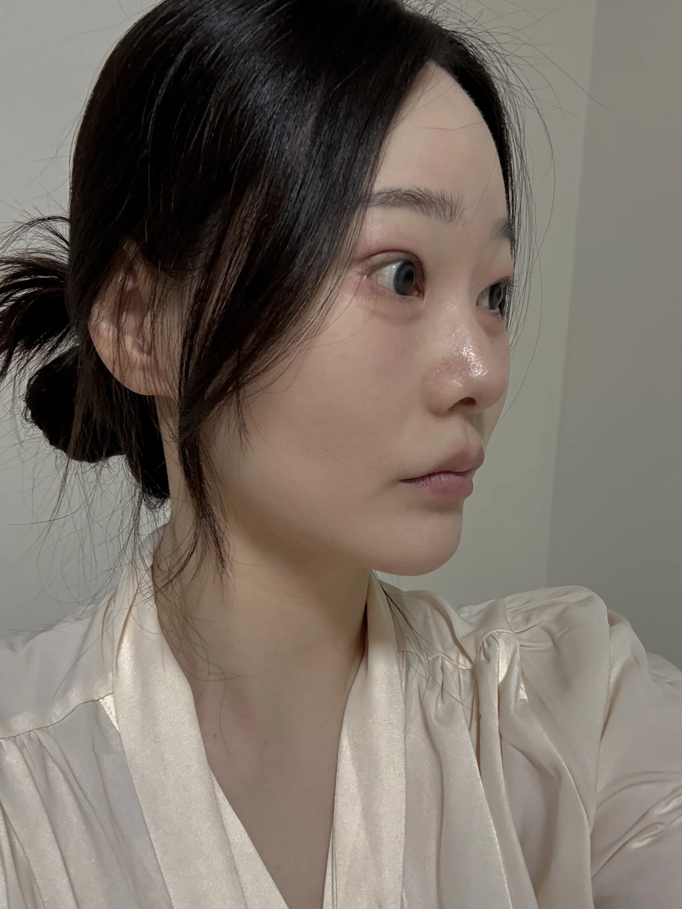 Revision double-eyelid surgery, eye-opening correction and Wonder canthoplasty: three months · Case 061 at Answer Plastic Surgery. Angled view — 1 month, revision double-eyelid surgery, eye-opening correction and wonder canthoplasty at Answer Plastic Surgery (case 061).
