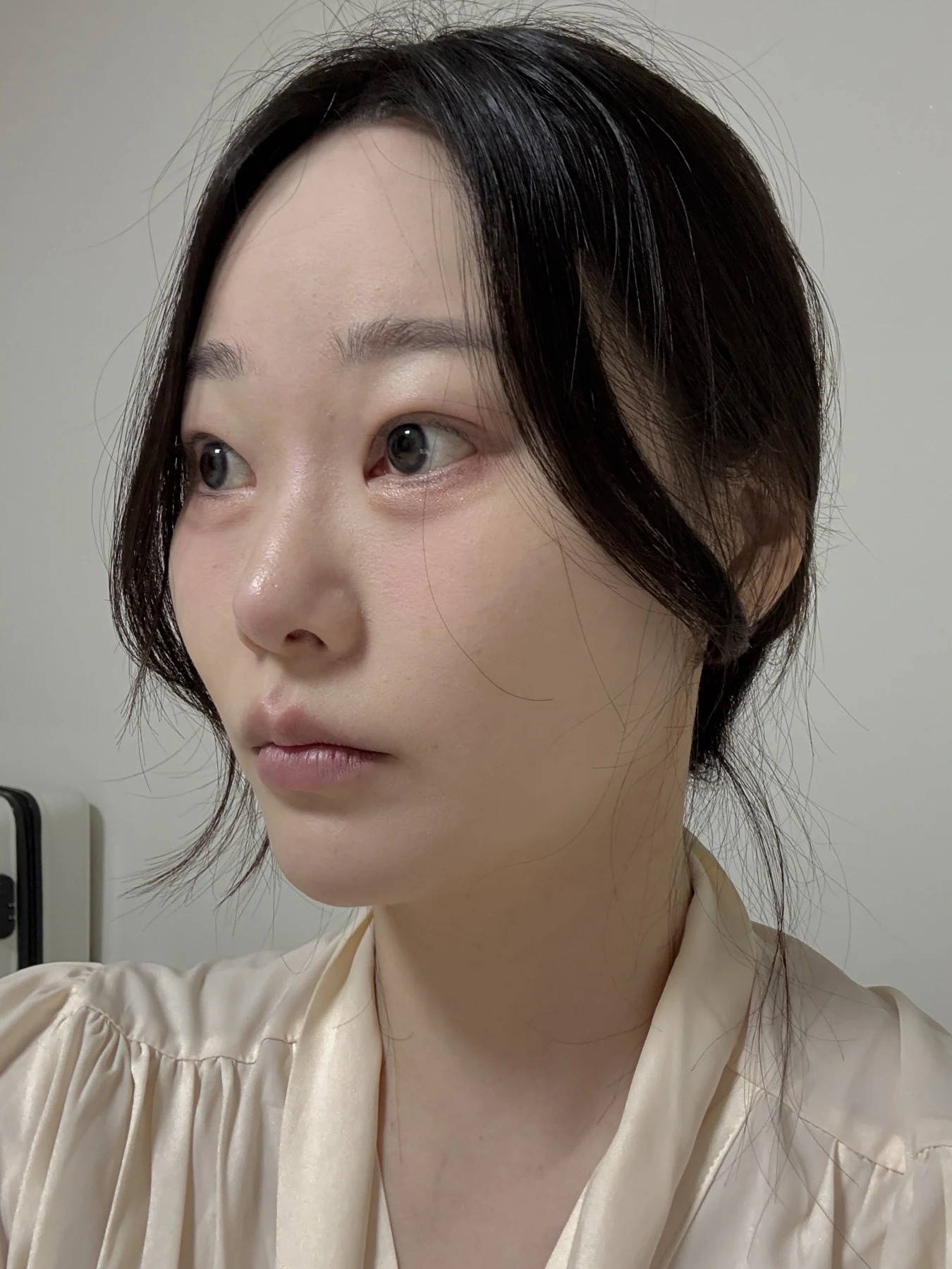 Revision double-eyelid surgery, eye-opening correction and Wonder canthoplasty: three months · Case 061 at Answer Plastic Surgery. Angled view — 1 month, revision double-eyelid surgery, eye-opening correction and wonder canthoplasty at Answer Plastic Surgery (case 061).