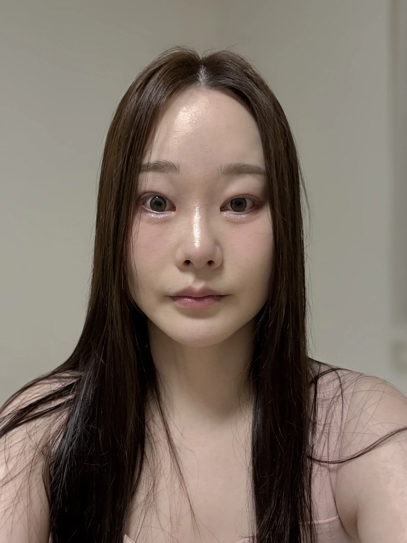 Revision double-eyelid surgery, eye-opening correction and Wonder canthoplasty: three months · Case 061 at Answer Plastic Surgery. Front view — 2 months, revision double-eyelid surgery, eye-opening correction and wonder canthoplasty at Answer Plastic Surgery (case 061).