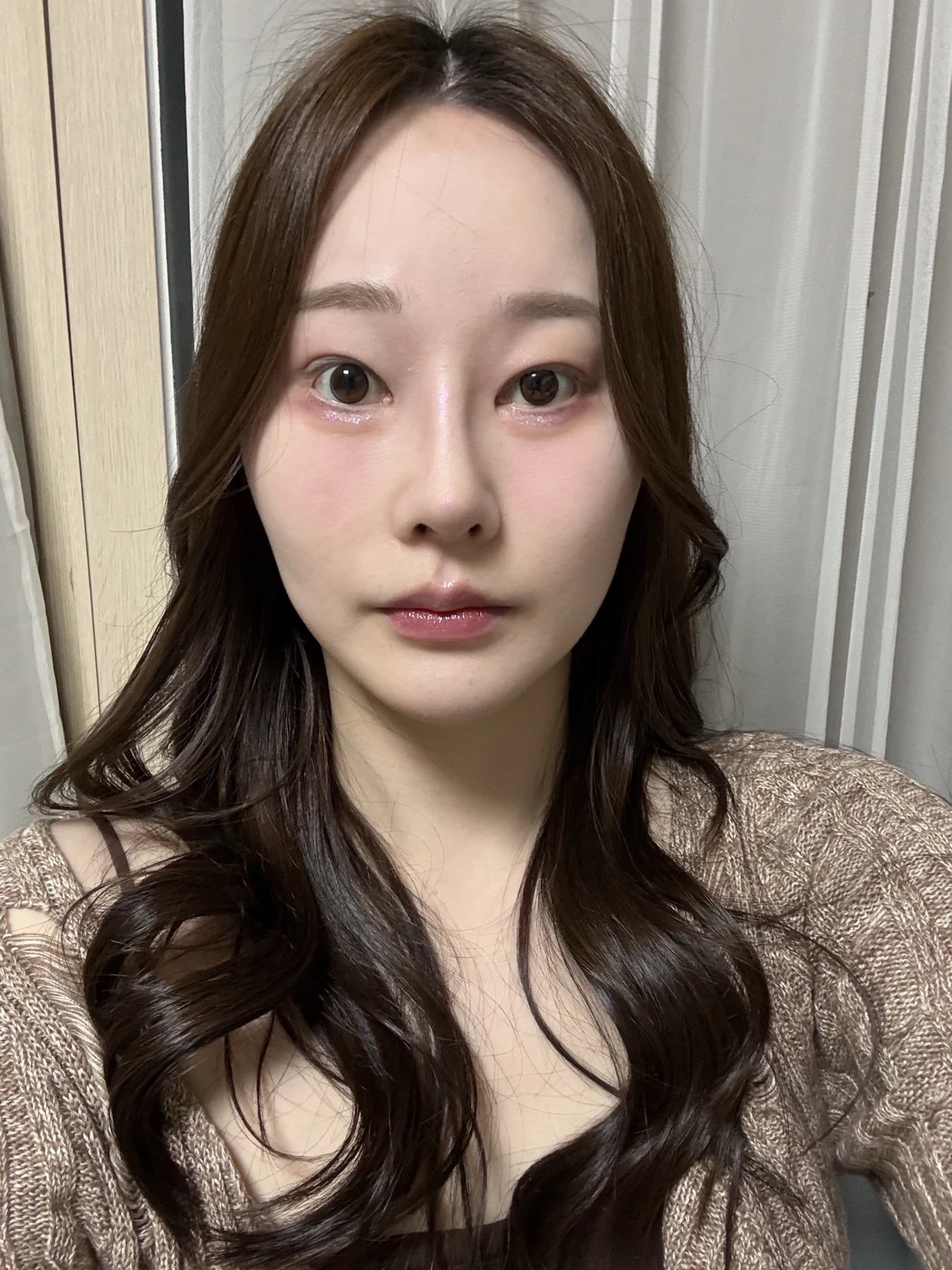 Revision double-eyelid surgery, eye-opening correction and Wonder canthoplasty: three months · Case 061 at Answer Plastic Surgery. Front view — 3 months, revision double-eyelid surgery, eye-opening correction and wonder canthoplasty at Answer Plastic Surgery (case 061).