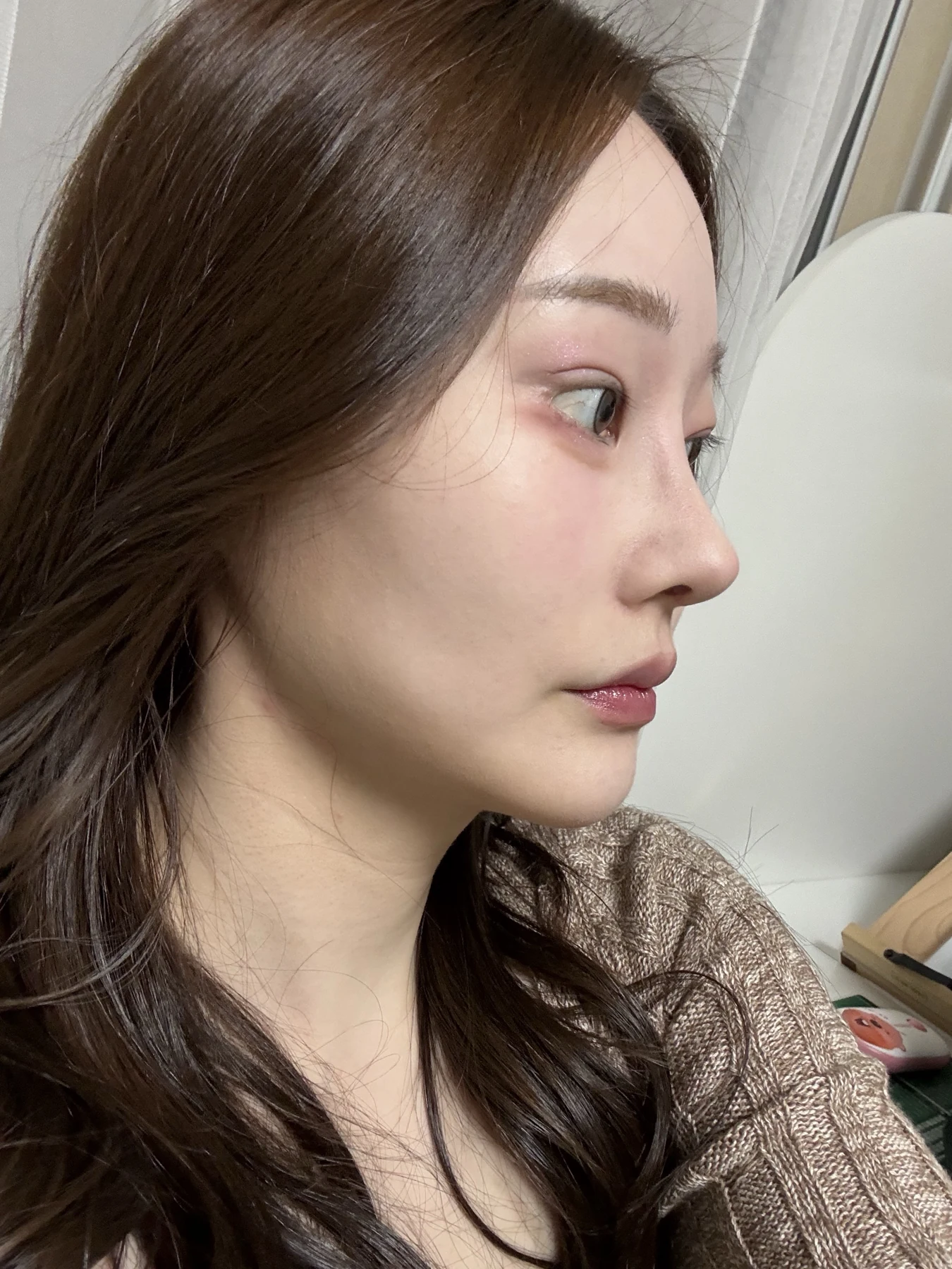 Revision double-eyelid surgery, eye-opening correction and Wonder canthoplasty: three months · Case 061 at Answer Plastic Surgery. Angled view — 3 months, revision double-eyelid surgery, eye-opening correction and wonder canthoplasty at Answer Plastic Surgery (case 061).