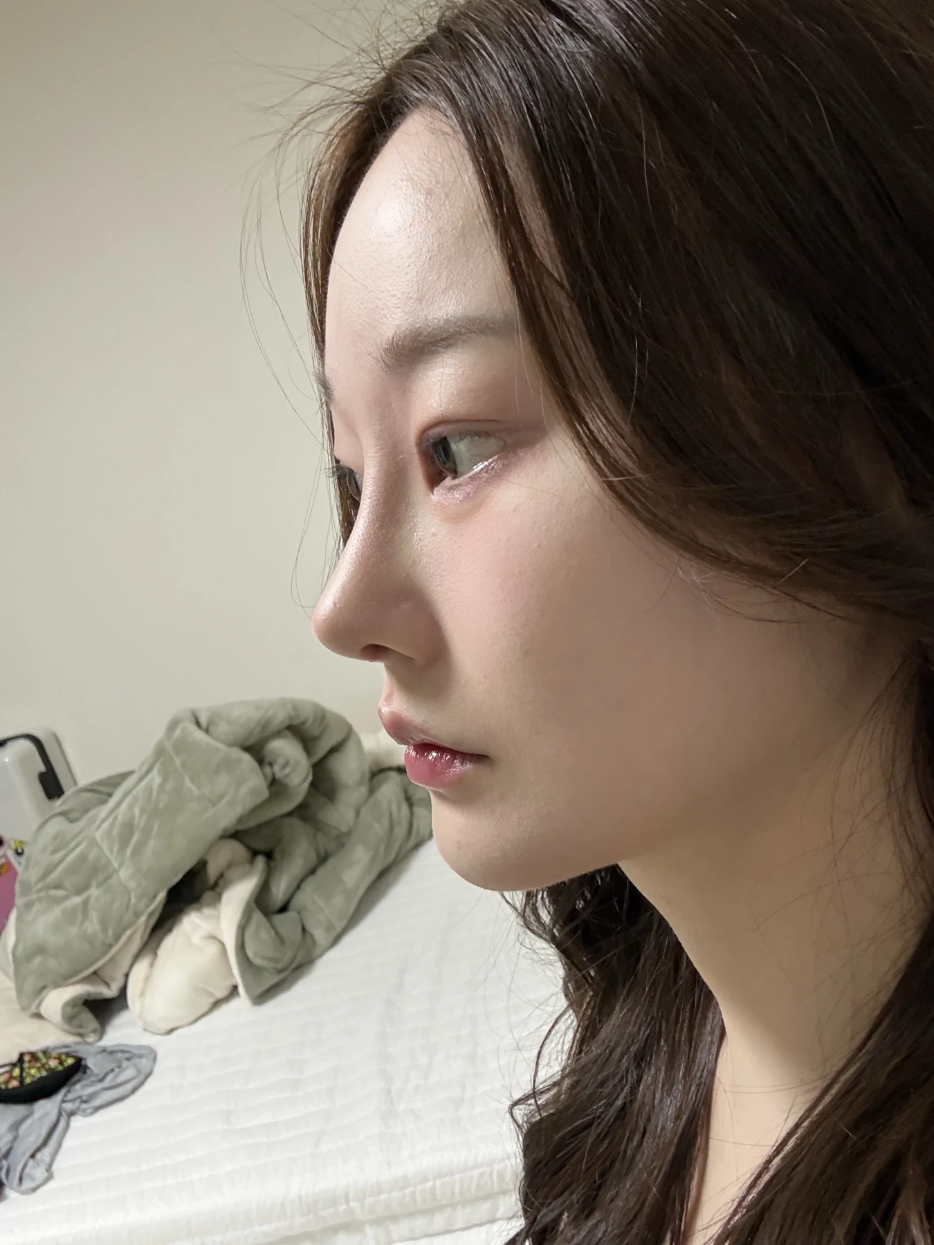 Revision double-eyelid surgery, eye-opening correction and Wonder canthoplasty: three months · Case 061 at Answer Plastic Surgery. Angled view — 3 months, revision double-eyelid surgery, eye-opening correction and wonder canthoplasty at Answer Plastic Surgery (case 061).