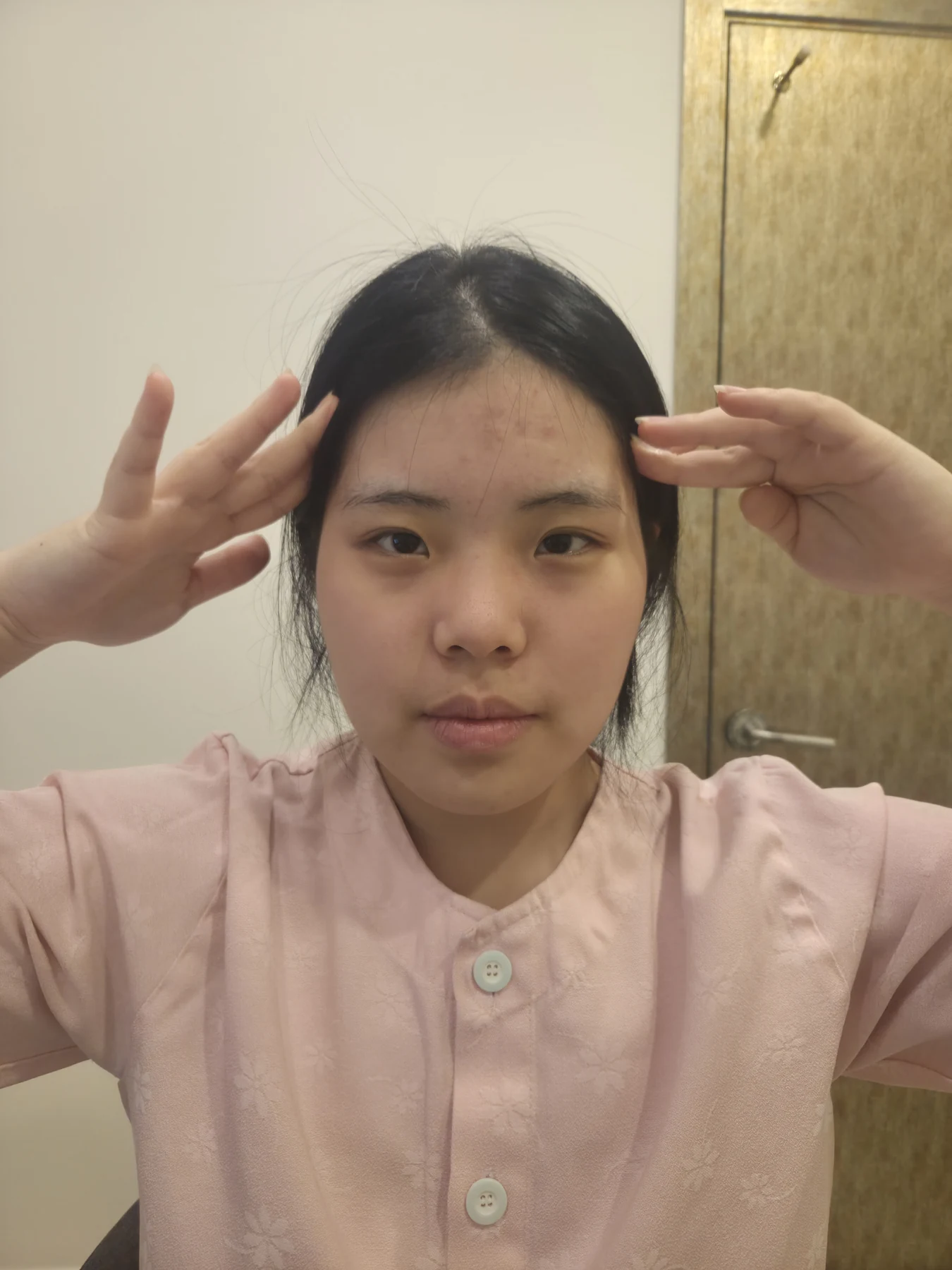 Eye-area surgery: before and two-month follow-up · Case 062 at Answer Plastic Surgery. Front view — before, eye-area surgery at Answer Plastic Surgery (case 062).