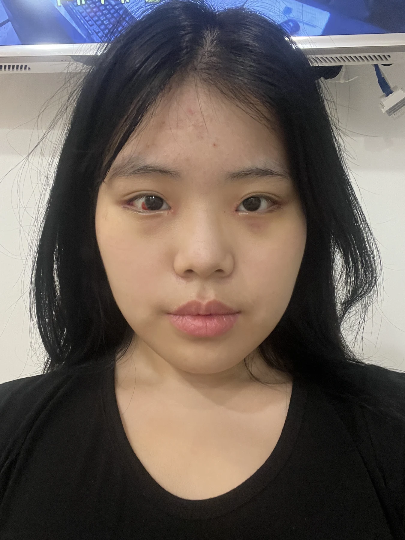 Eye-area surgery: before and two-month follow-up · Case 062 at Answer Plastic Surgery. Front view — 1 week, eye-area surgery at Answer Plastic Surgery (case 062).