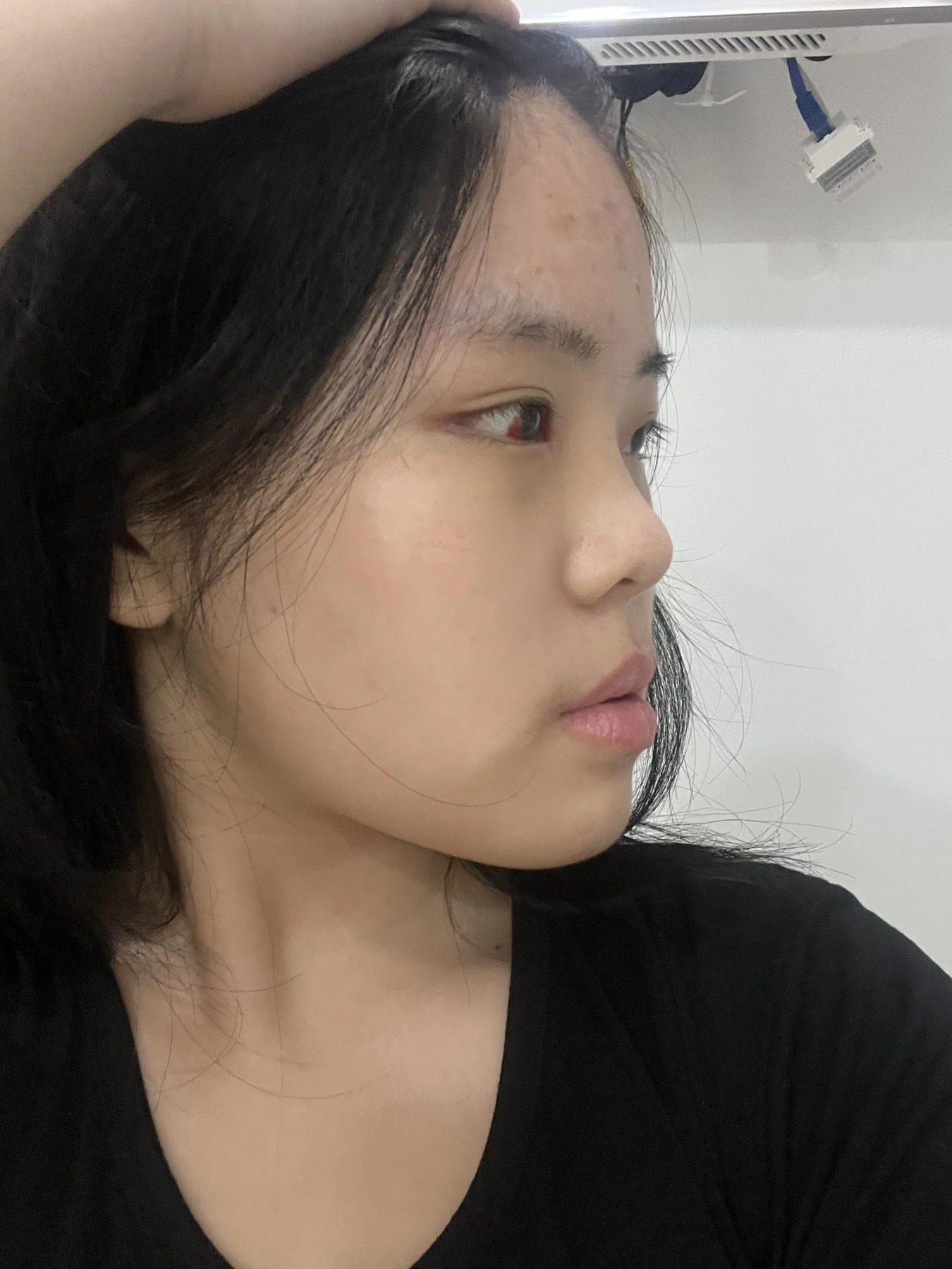 Eye-area surgery: before and two-month follow-up · Case 062 at Answer Plastic Surgery. Three-quarter view — 1 week, eye-area surgery at Answer Plastic Surgery (case 062).