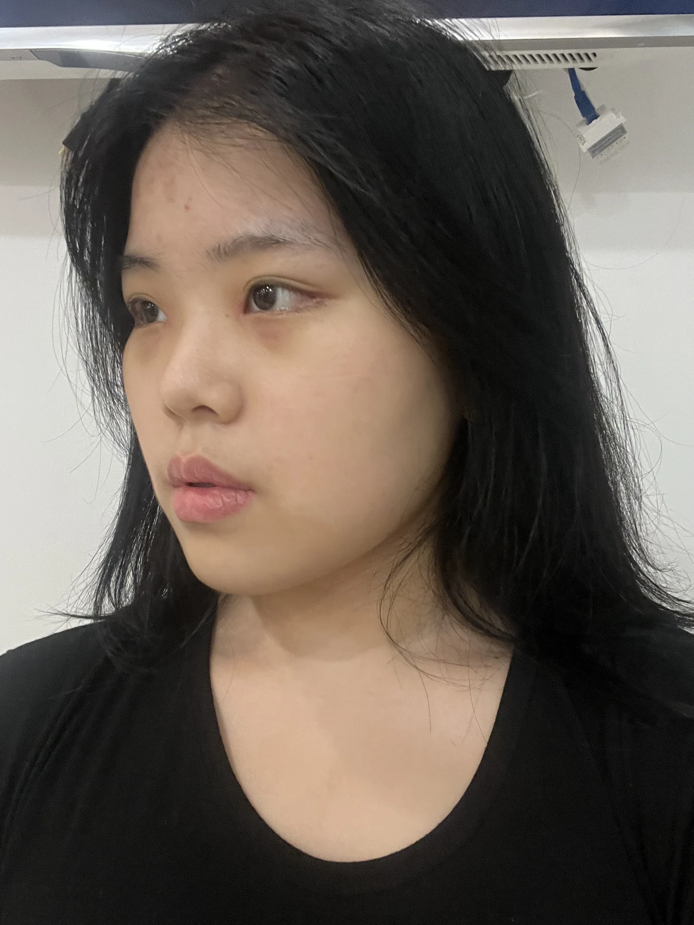 Eye-area surgery: before and two-month follow-up · Case 062 at Answer Plastic Surgery. Opposite three-quarter view — 1 week, eye-area surgery at Answer Plastic Surgery (case 062).