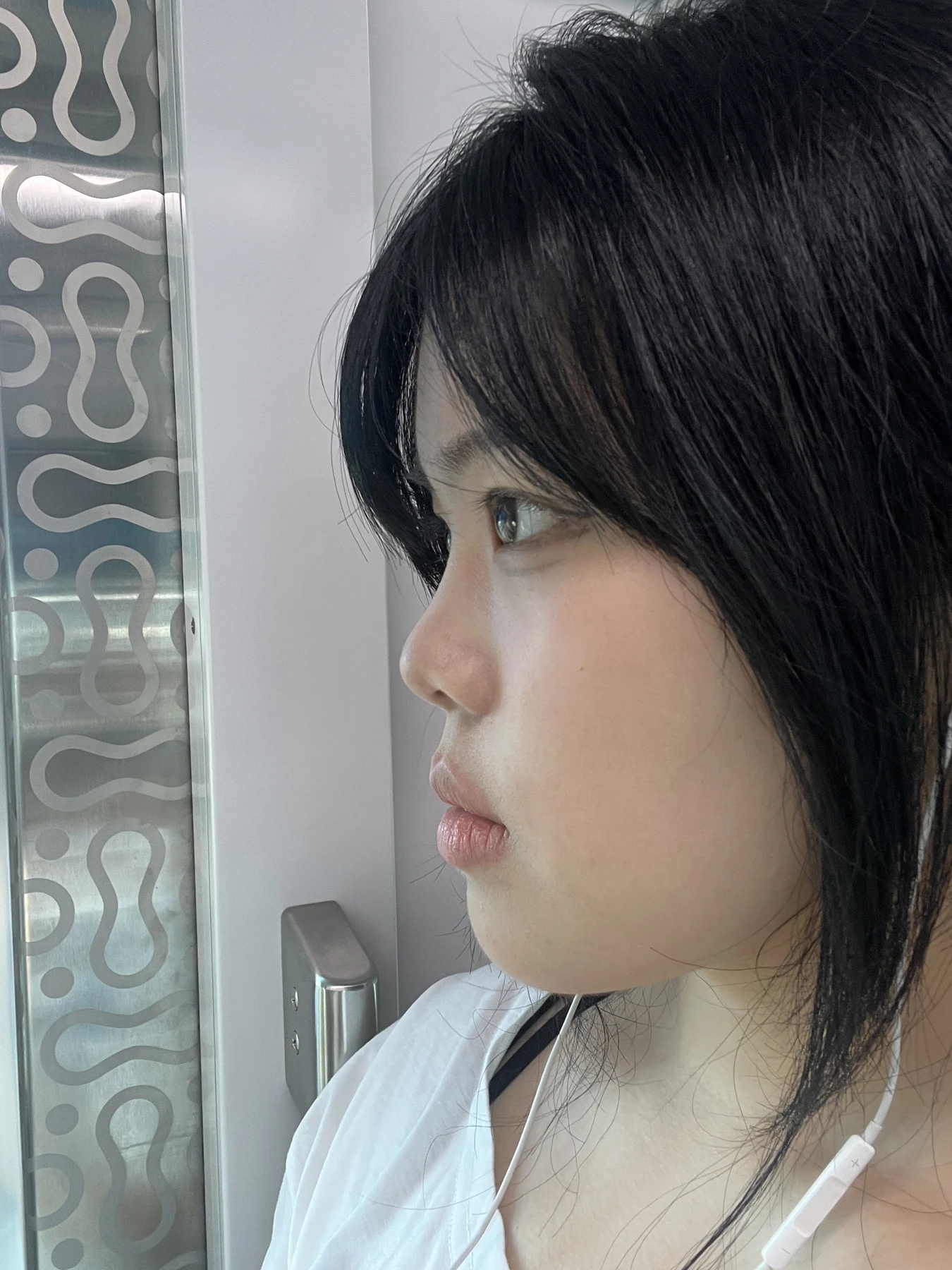 Eye-area surgery: before and two-month follow-up · Case 062 at Answer Plastic Surgery. Three-quarter view — 1 month, eye-area surgery at Answer Plastic Surgery (case 062).