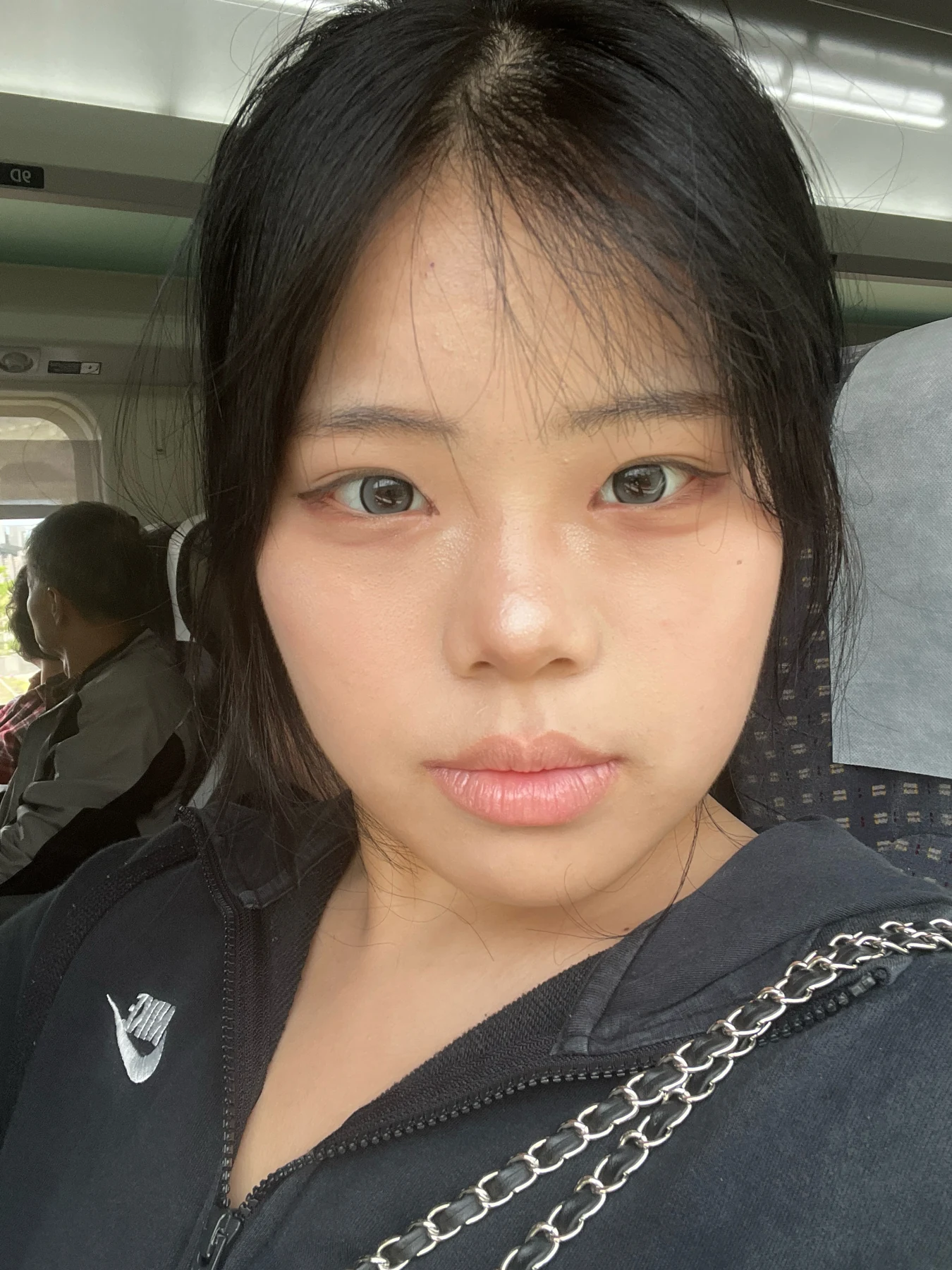 Eye-area surgery: before and two-month follow-up · Case 062 at Answer Plastic Surgery. Front view — 2 months, eye-area surgery at Answer Plastic Surgery (case 062).